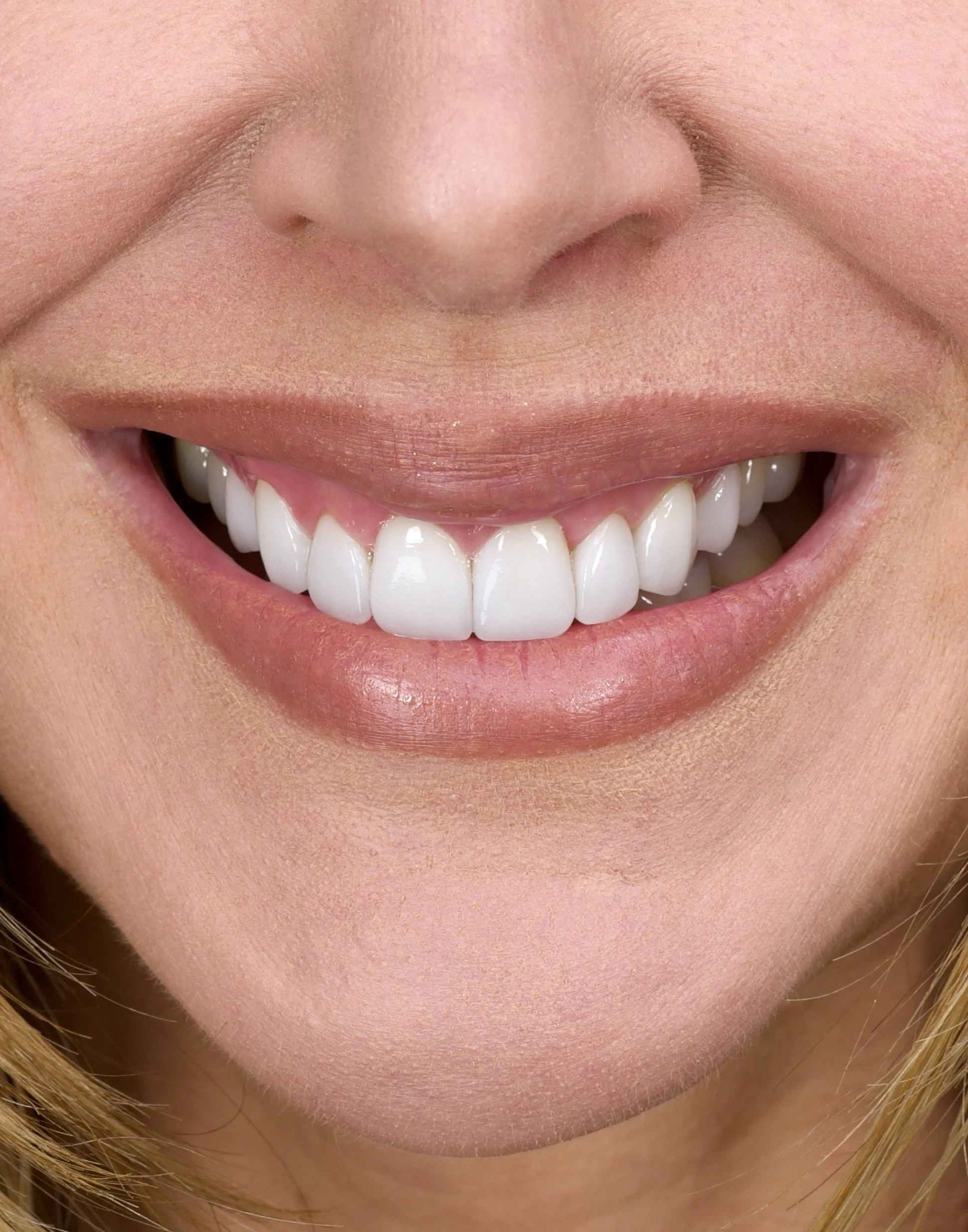 Porcelain Veneers by Jeremy Heldt, DDS in Newport Beach