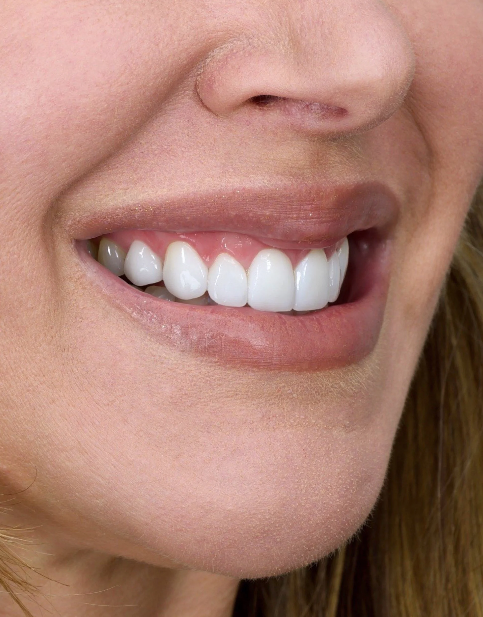 Porcelain Veneers by Jeremy Heldt, DDS in Newport Beach