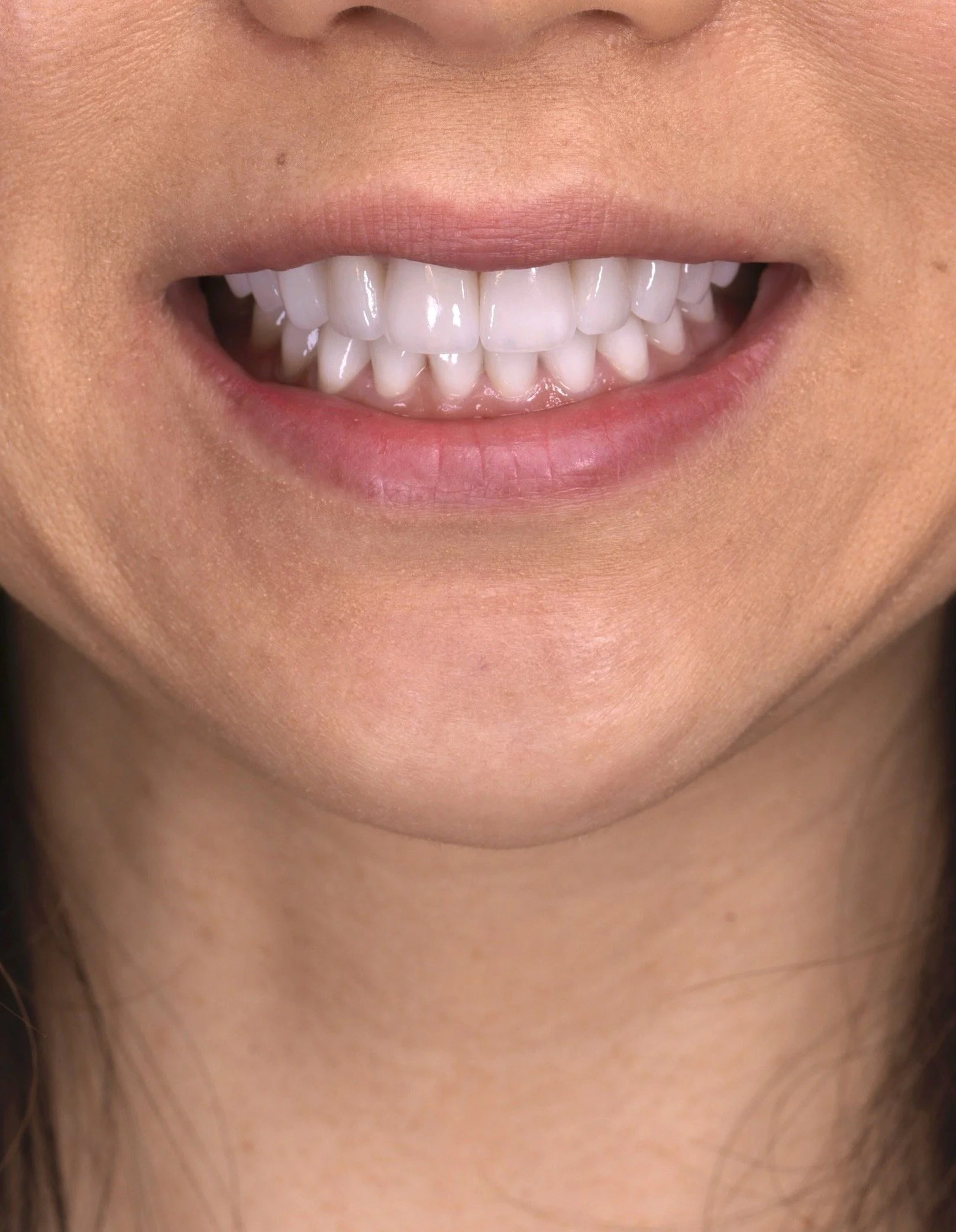 Porcelain Veneers by Jeremy Heldt, DDS in Newport Beach