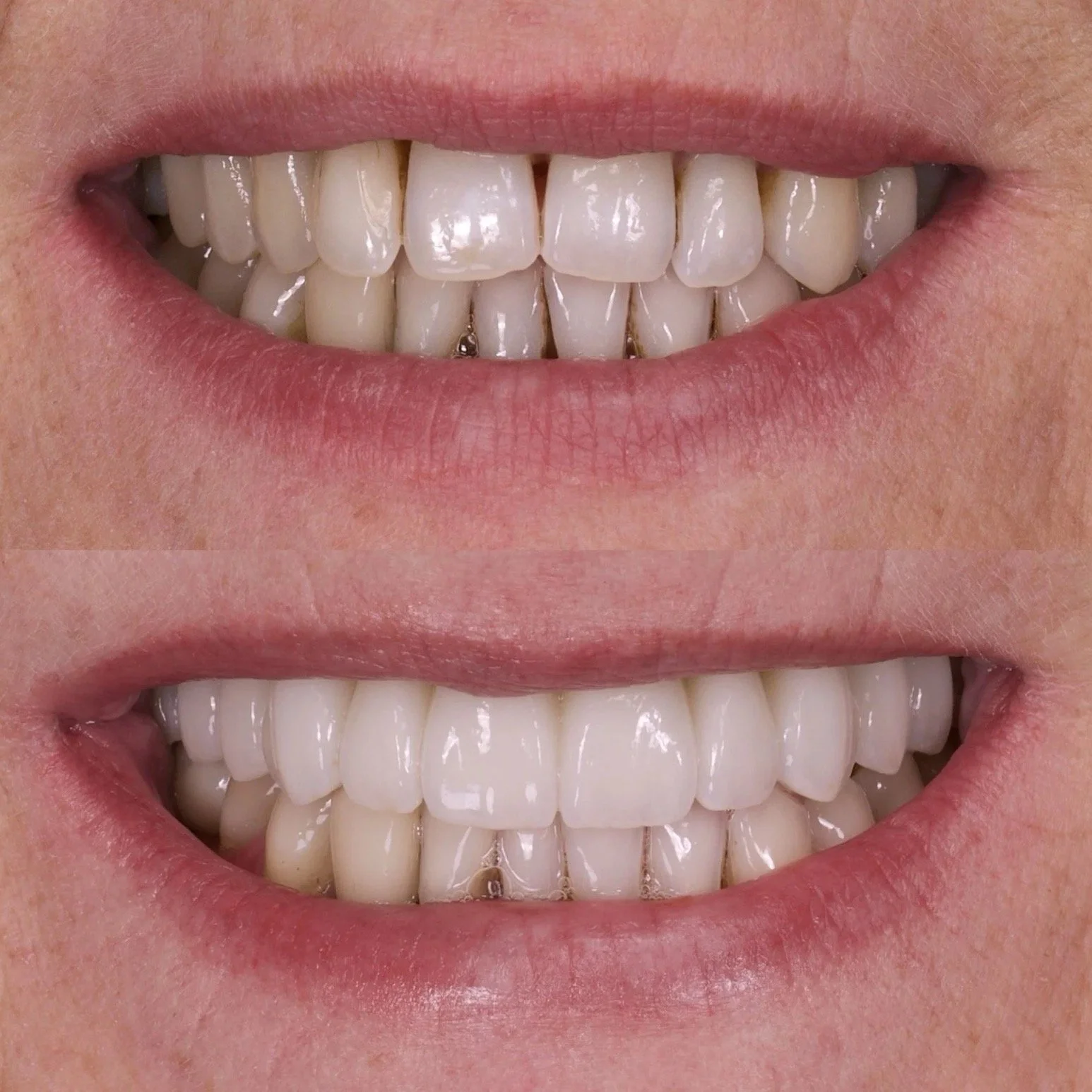Dental Implants by Jeremy Heldt, DDS in Newport Beach