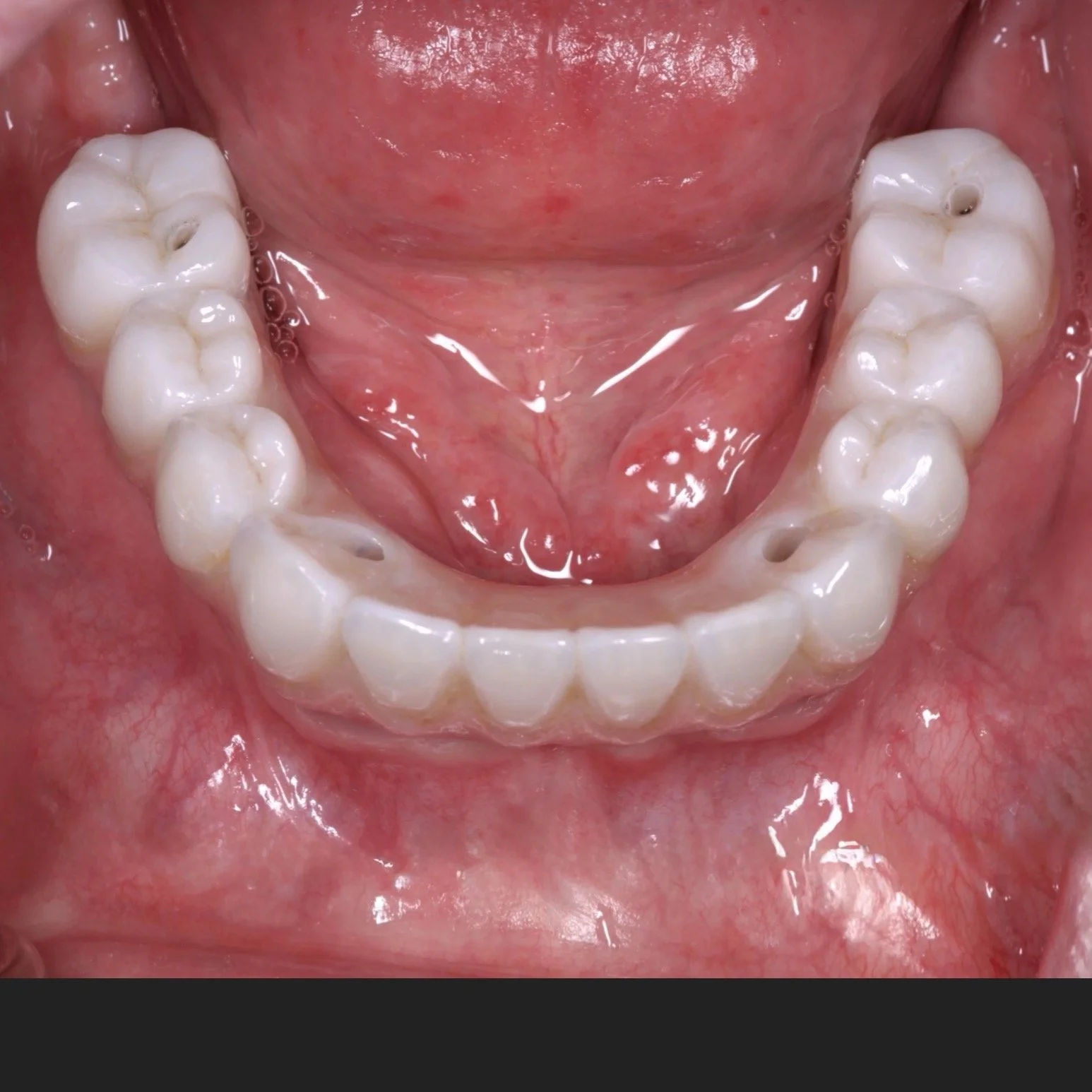 Dental Implants by Jeremy Heldt, DDS in Newport Beach