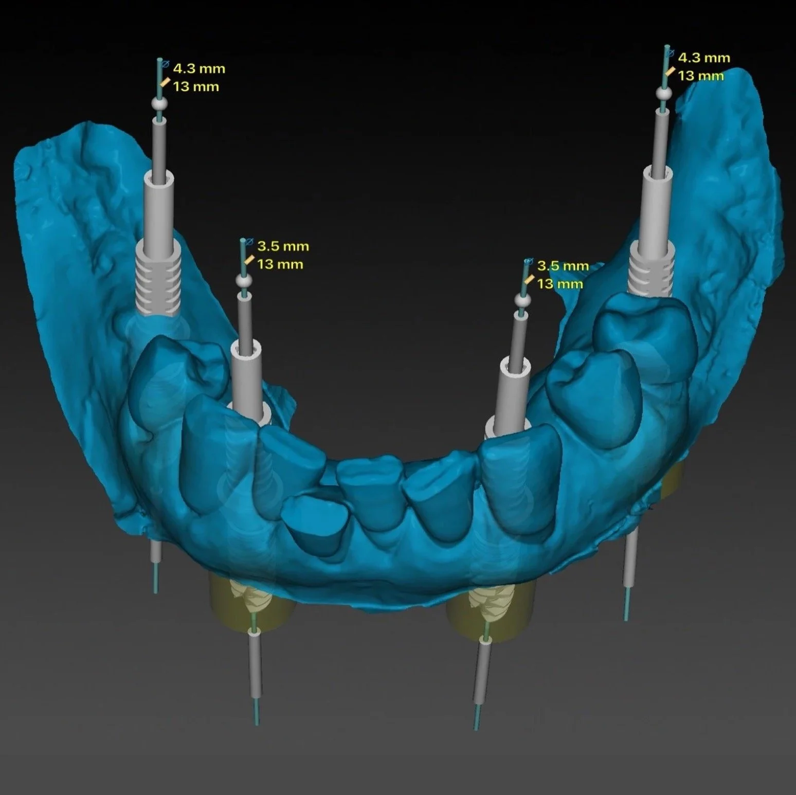 Dental Implants by Jeremy Heldt, DDS in Newport Beach
