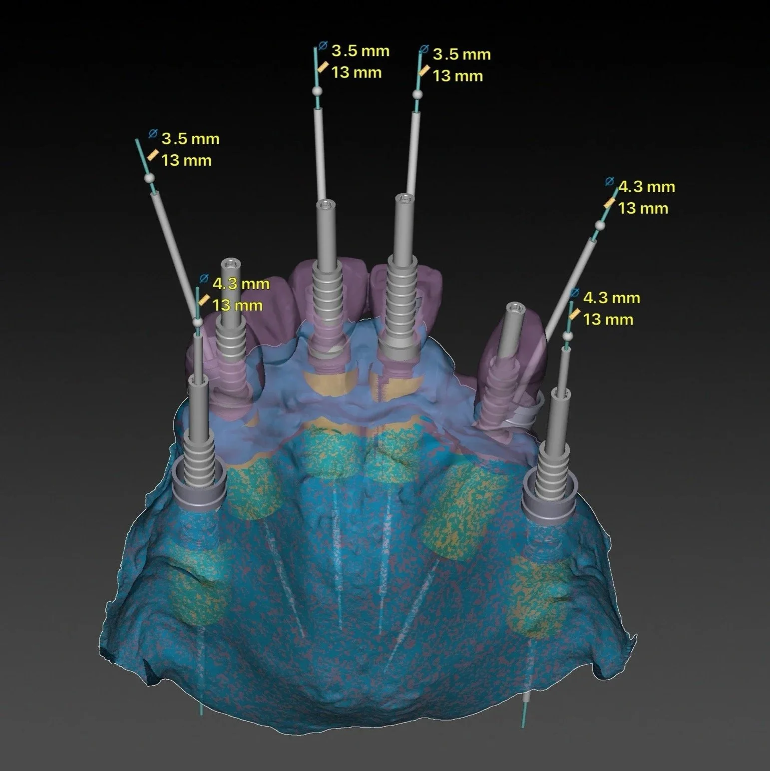 Dental Implants by Jeremy Heldt, DDS in Newport Beach