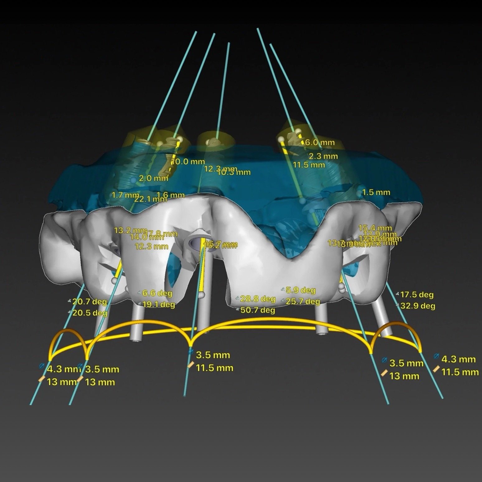 Dental Implants by Jeremy Heldt, DDS in Newport Beach