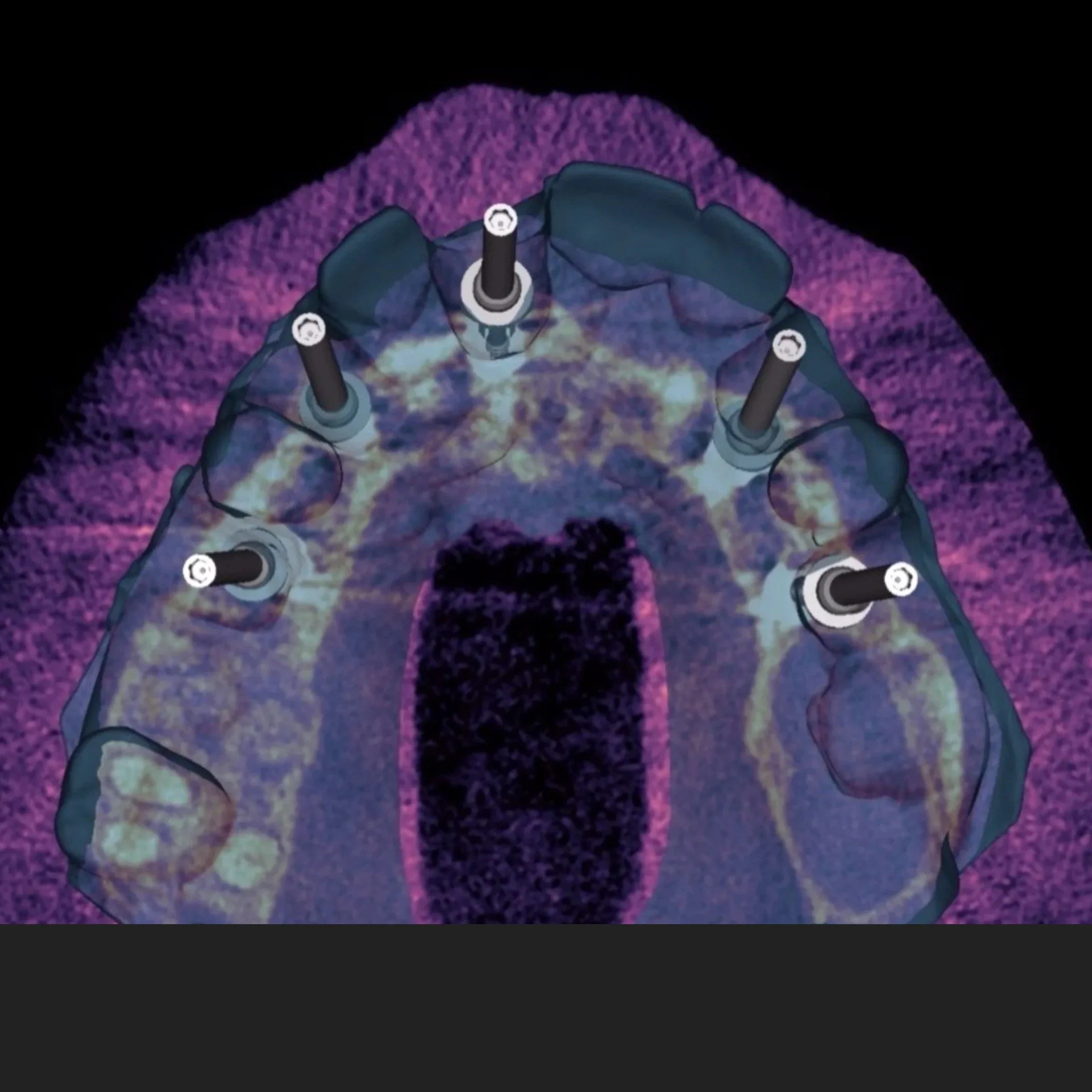Dental Implants by Jeremy Heldt, DDS in Newport Beach