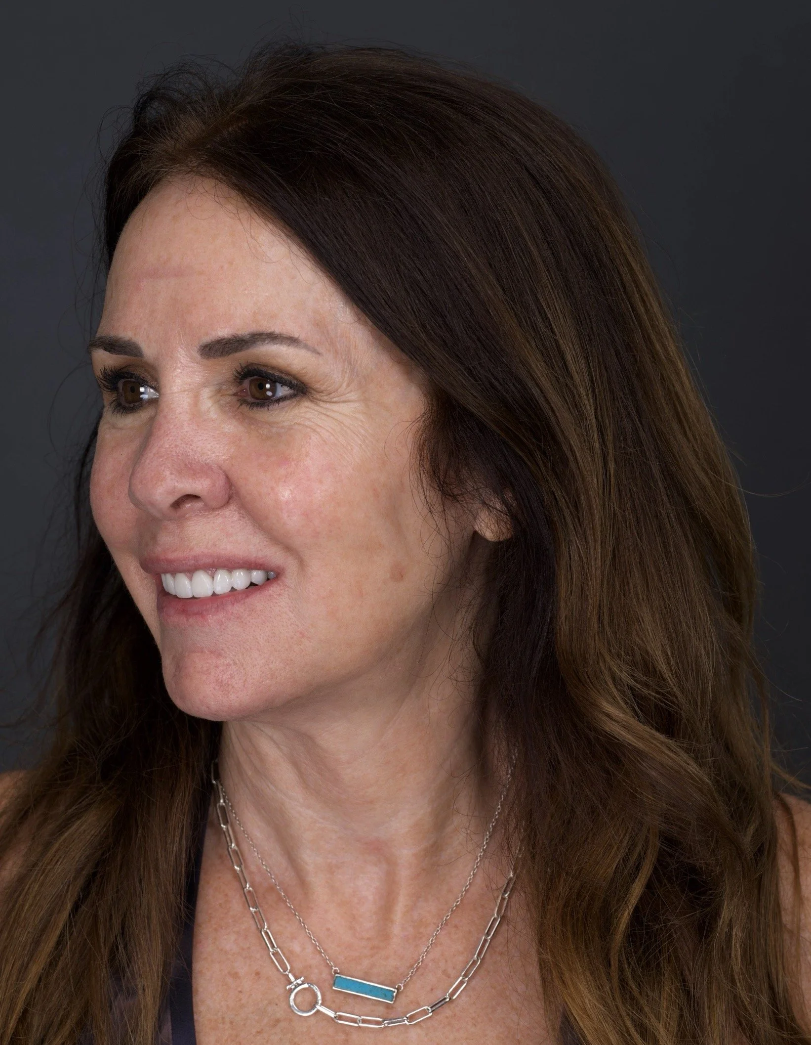 Porcelain Veneers by Jeremy Heldt, DDS in Newport Beach