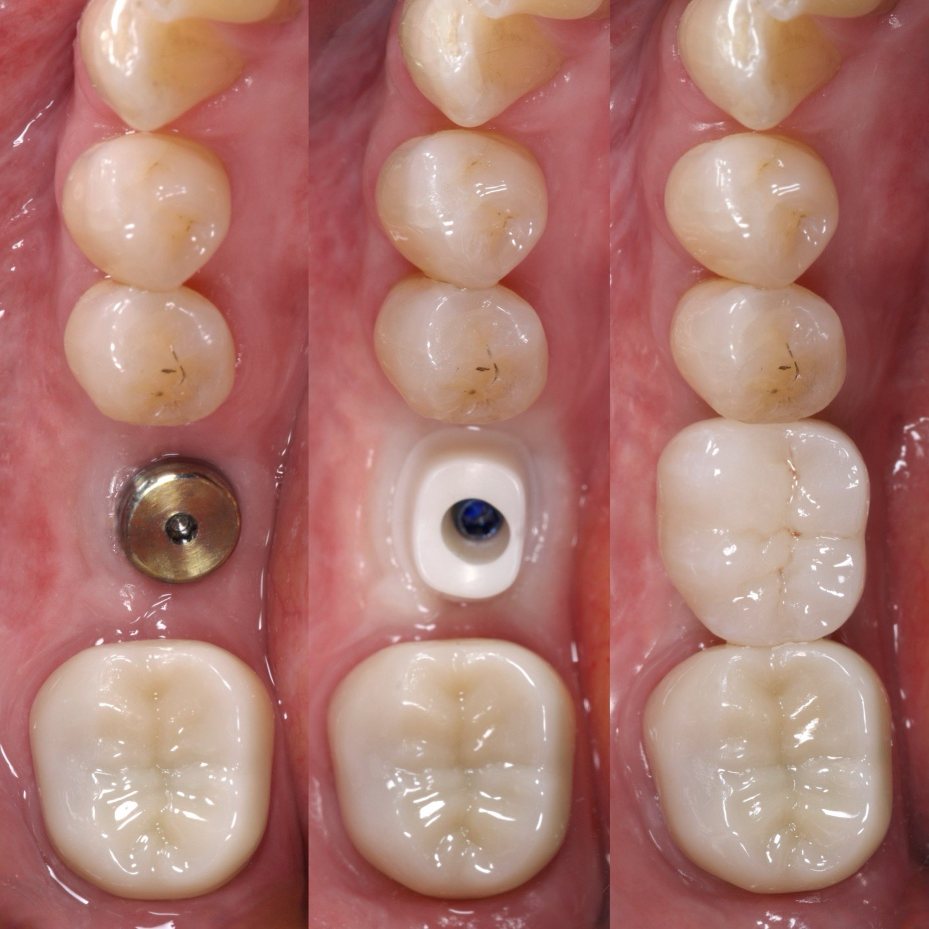 Dental Implants by Jeremy Heldt, DDS in Newport Beach