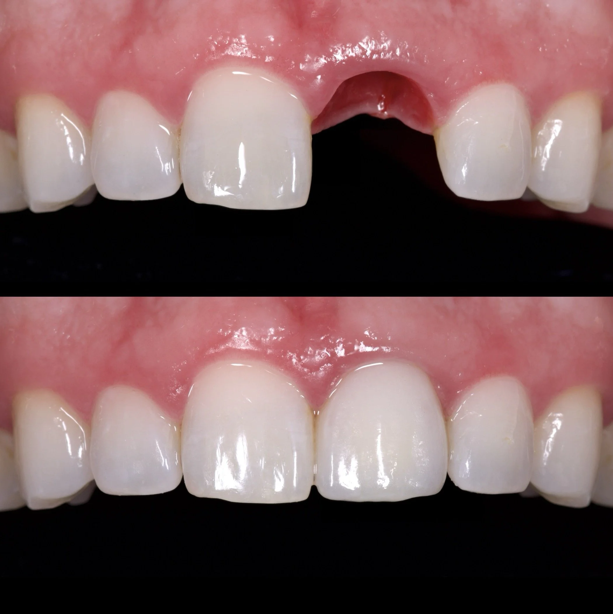 Dental Implants by Jeremy Heldt, DDS in Newport Beach