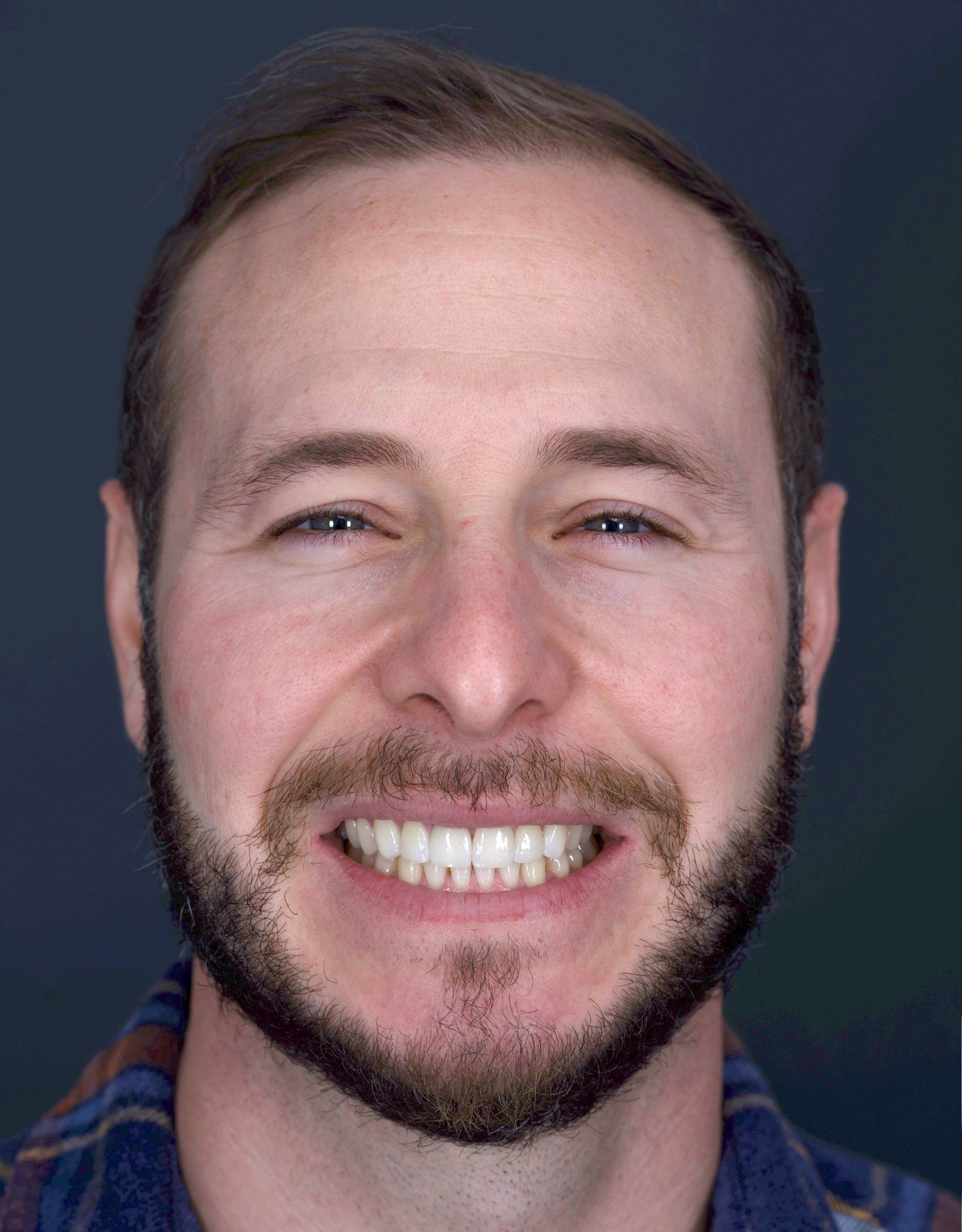 Veneers by Jeremy Heldt, DDS in Newport Beach