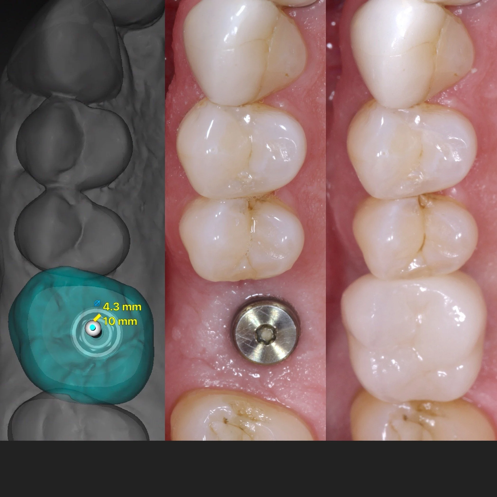Dental Implants by Jeremy Heldt, DDS in Newport Beach