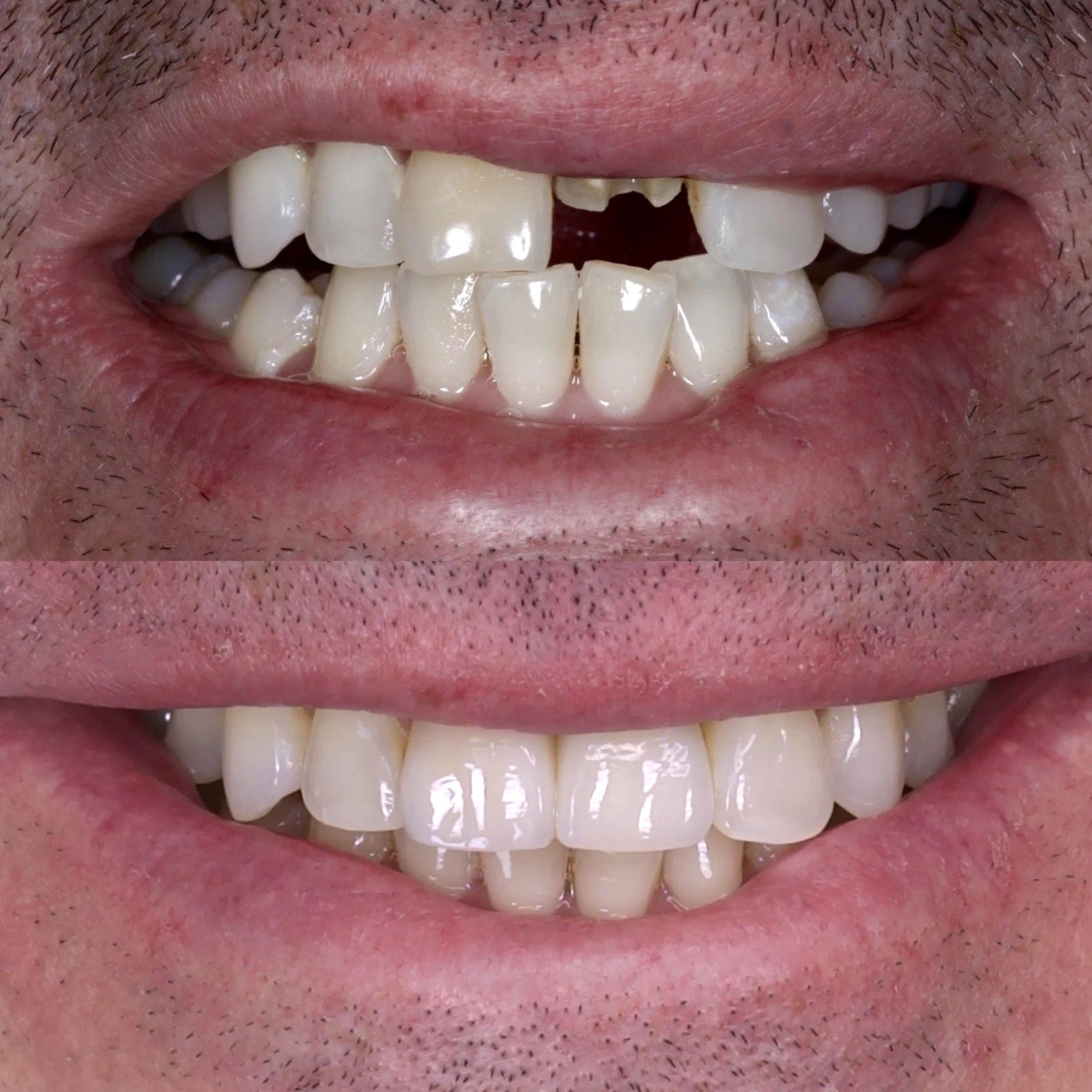 Dental Implants by Jeremy Heldt, DDS in Newport Beach