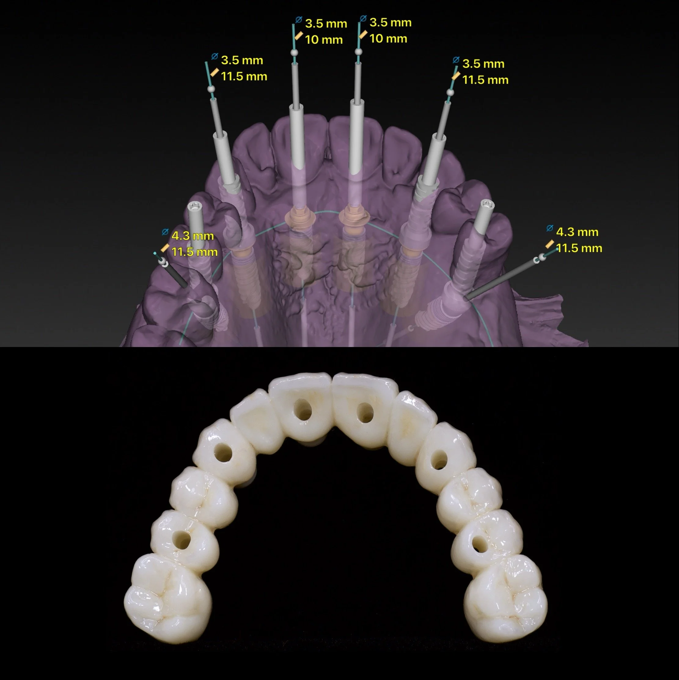 Dental Implants by Jeremy Heldt, DDS in Newport Beach