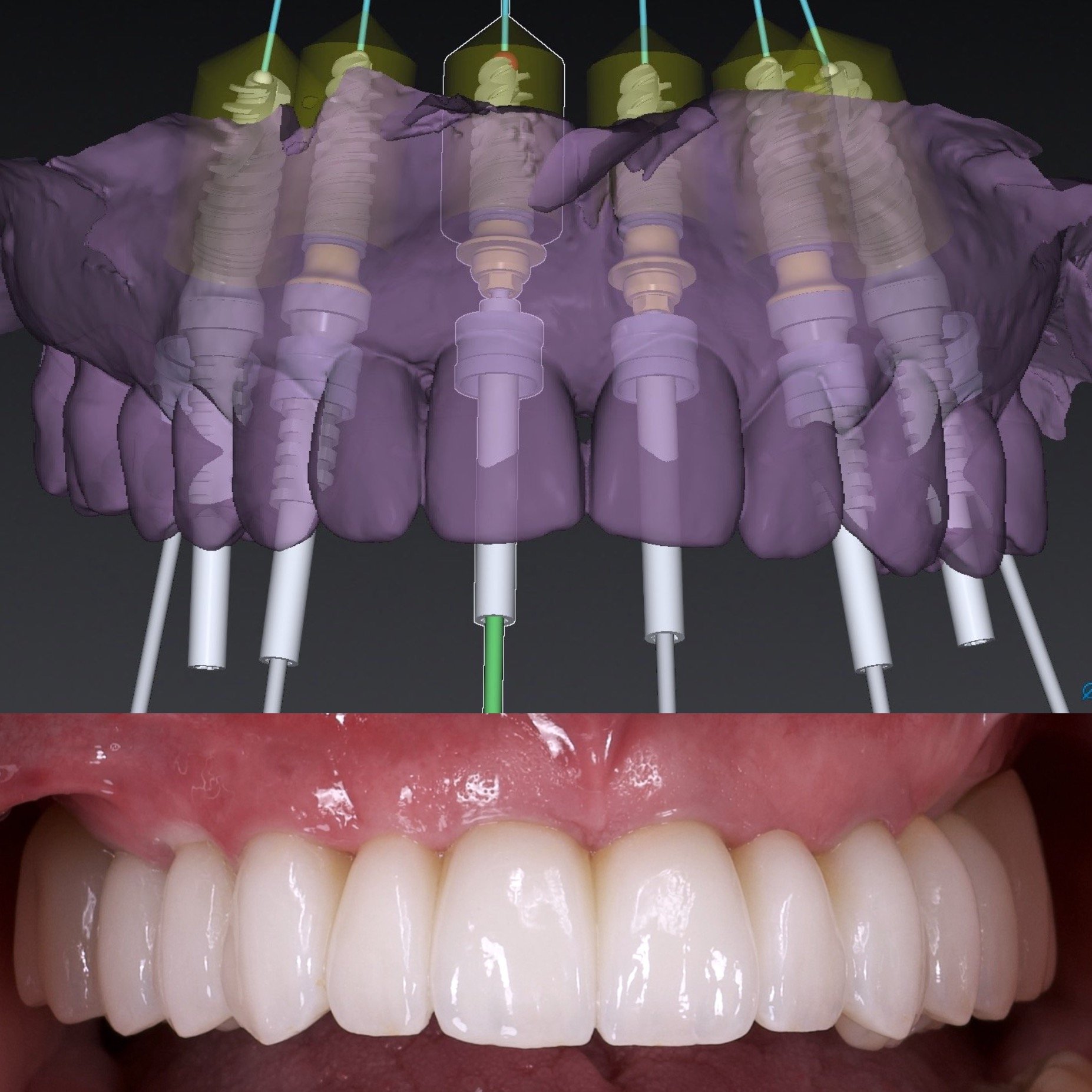 Dental Implants by Jeremy Heldt, DDS in Newport Beach