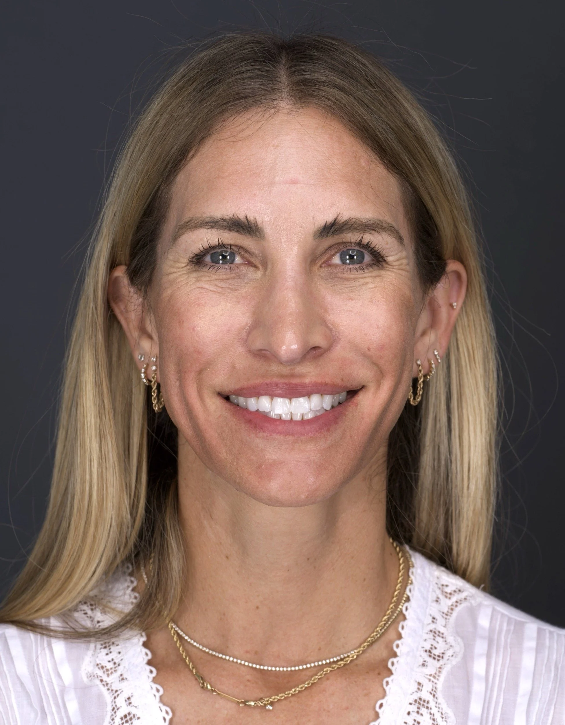 Veneers by Jeremy Heldt, DDS in Newport Beach