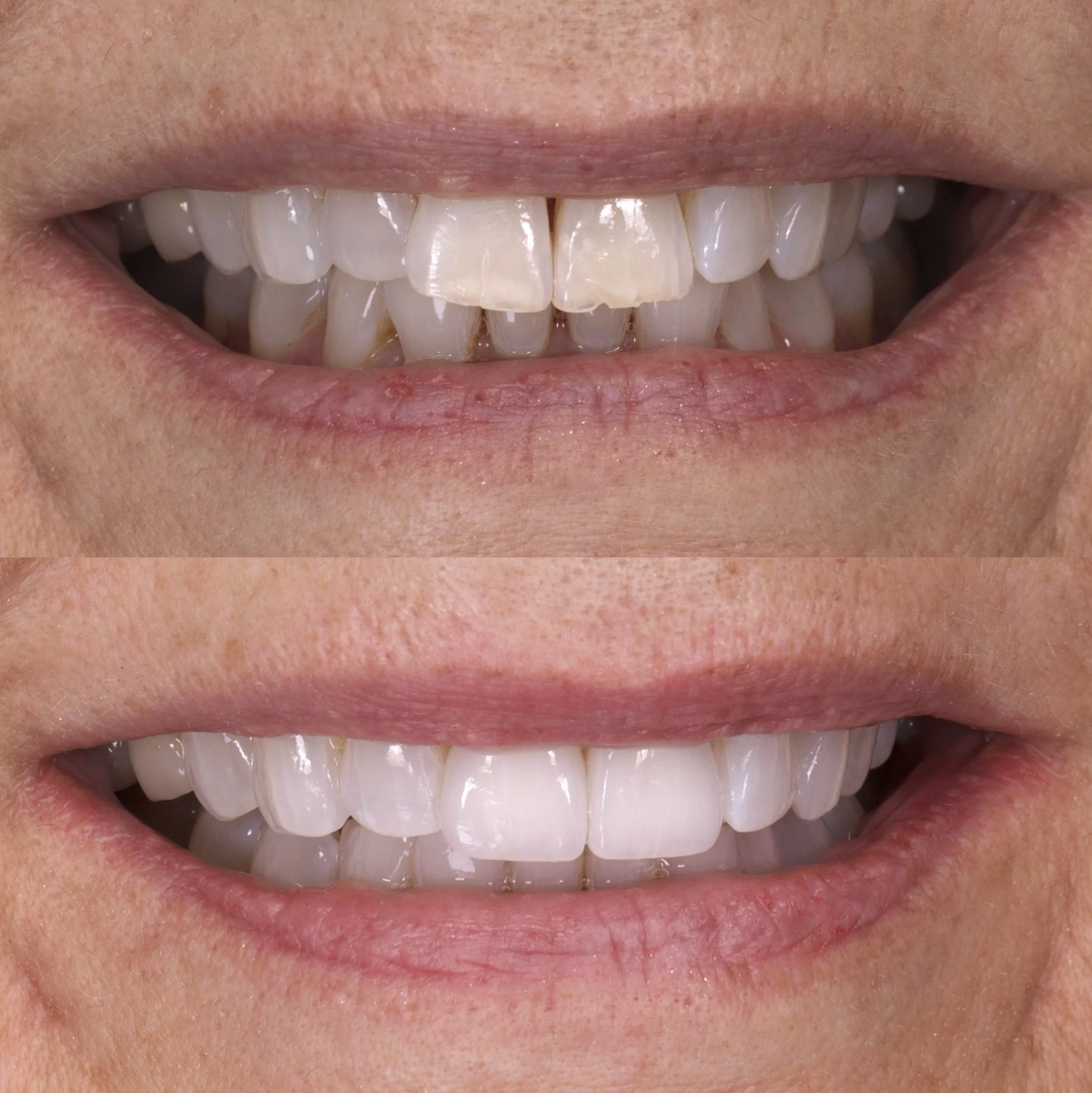 2 Natural High Translucency Porcelain Veneers