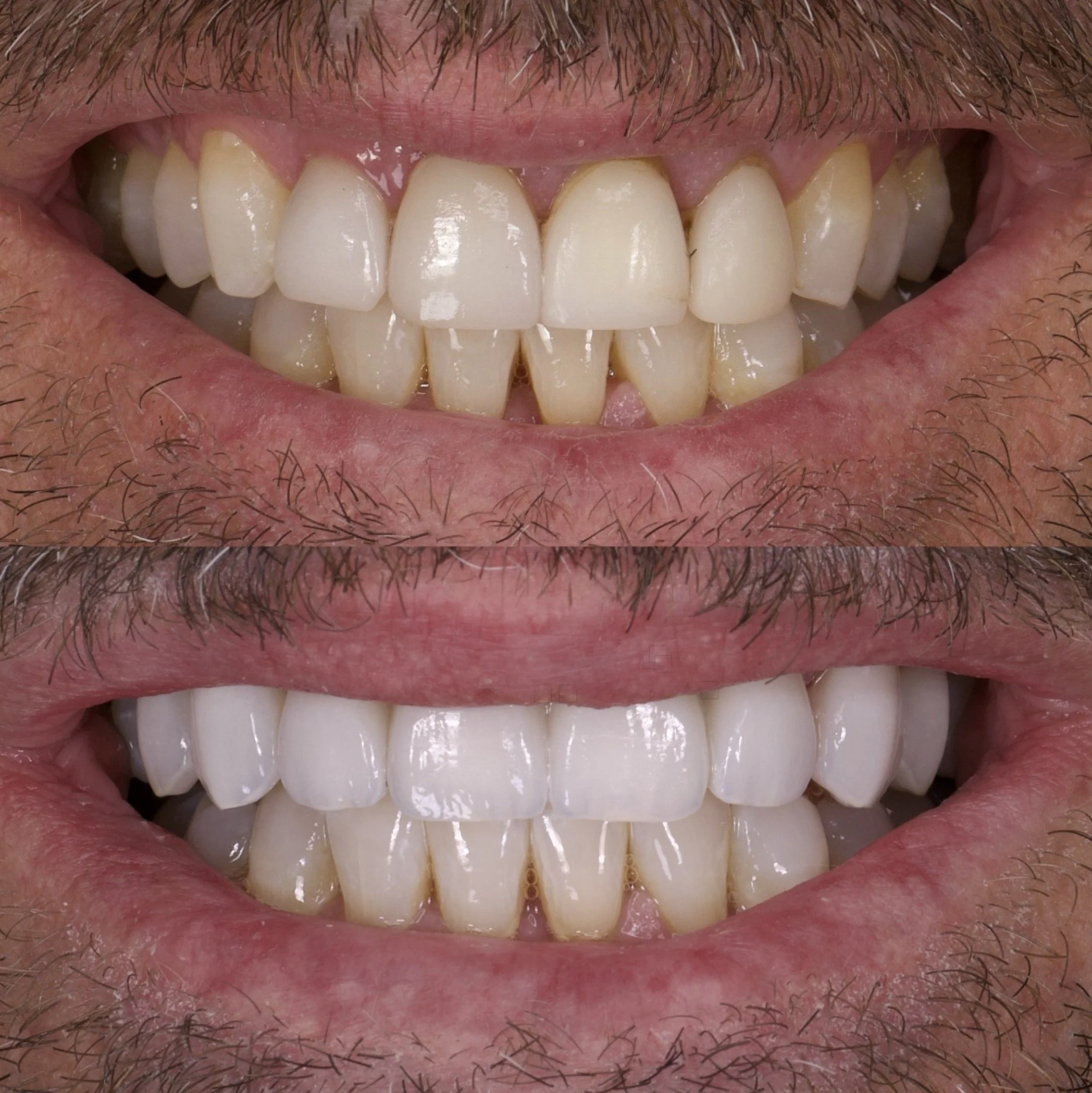 Revision Veneers Newport Beach by Cosmetic Dentist: Jeremy Heldt, DDS