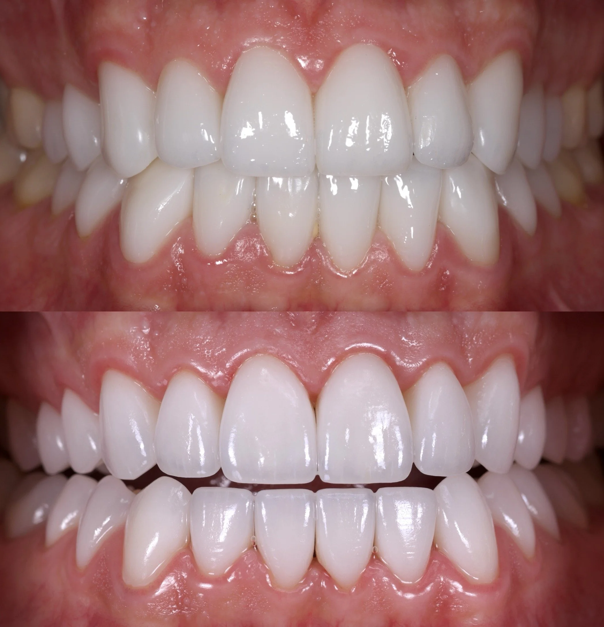28 Veneers in High Translucency BL2
