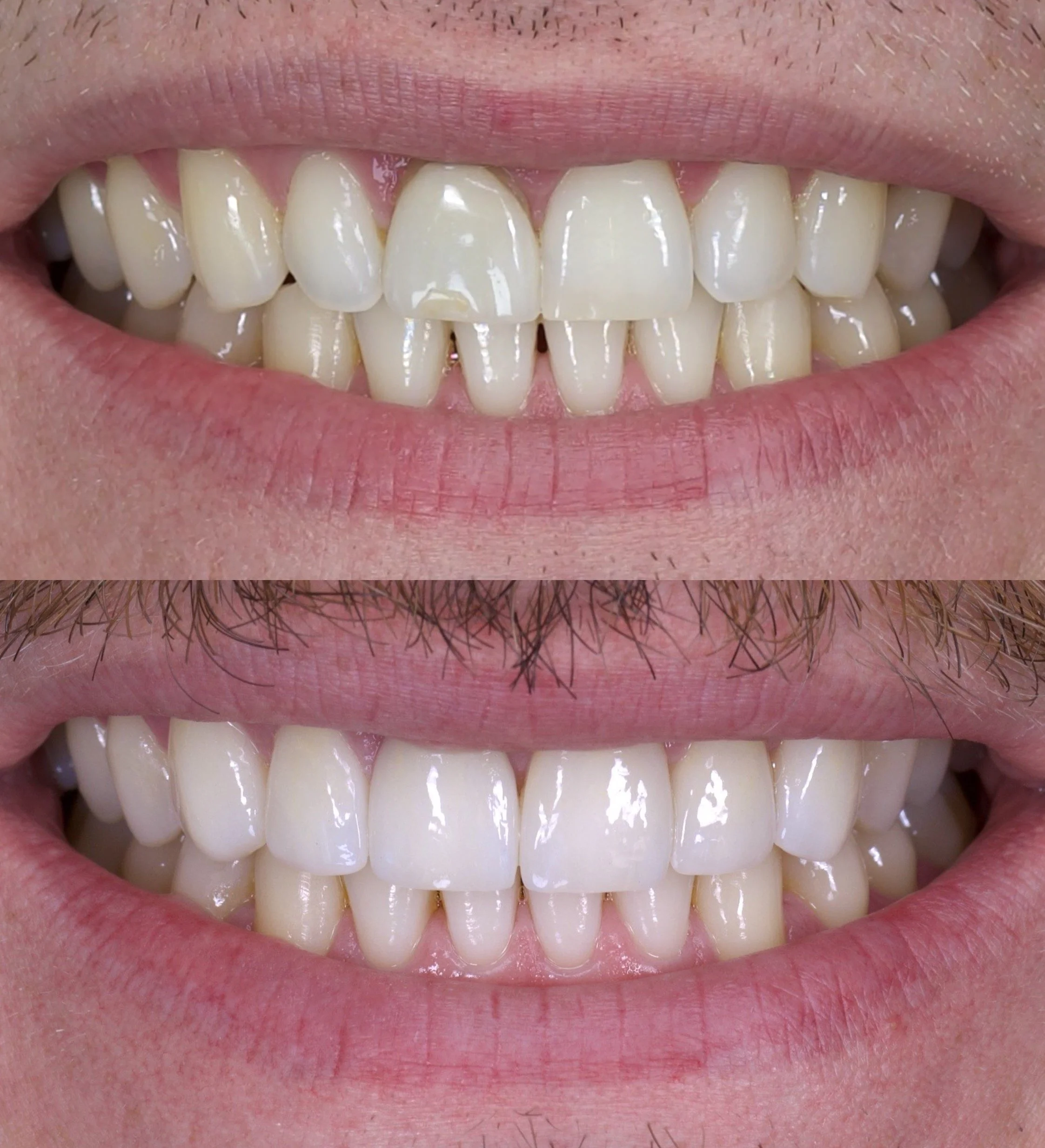 6 Veneers in Shade 0.5M1