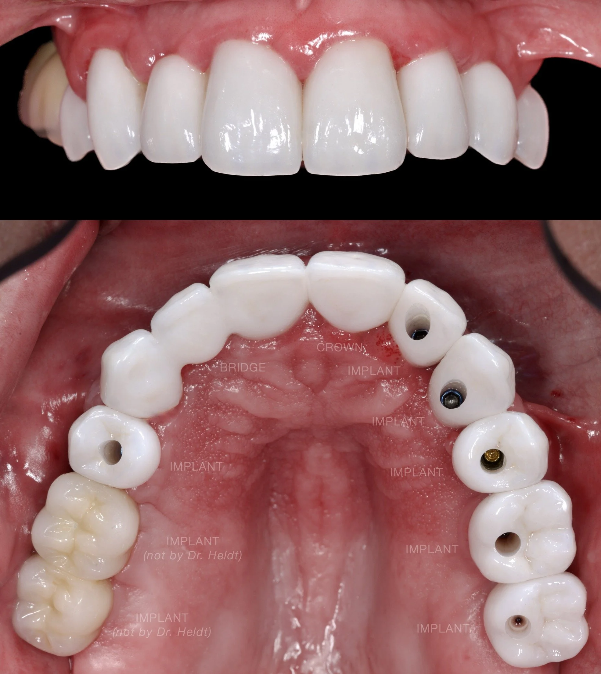All-on-6 Dental Implants + Single Implants