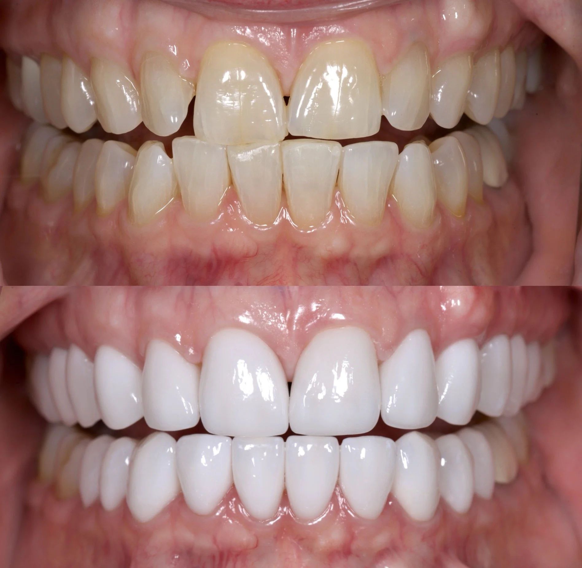 18 Veneers in Shade 0.5M1 (LT)