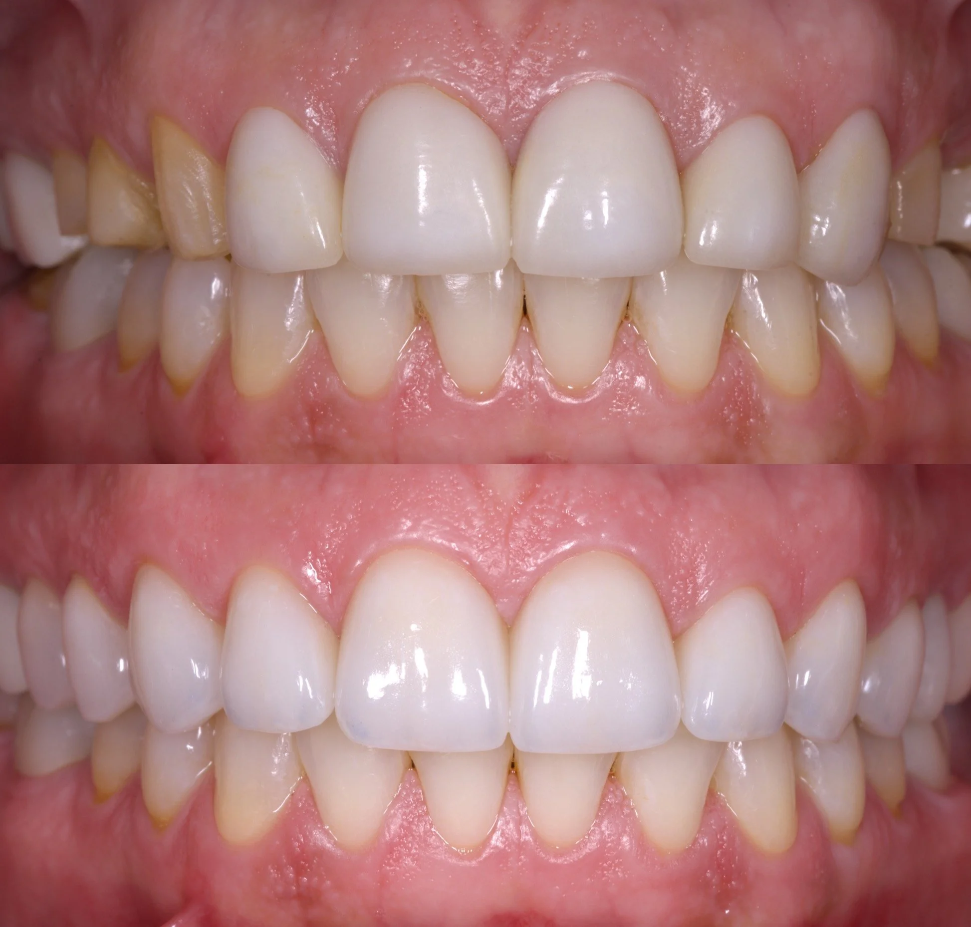 12 Veneers + 1 Implant in Shade 0.5M1