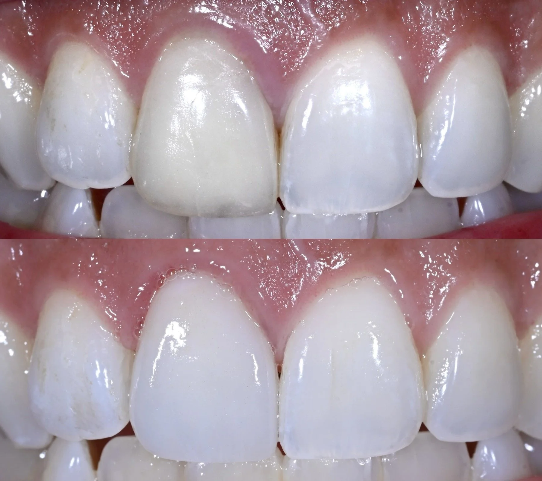 1 Feldspathic Veneer with Natural Aesthetics