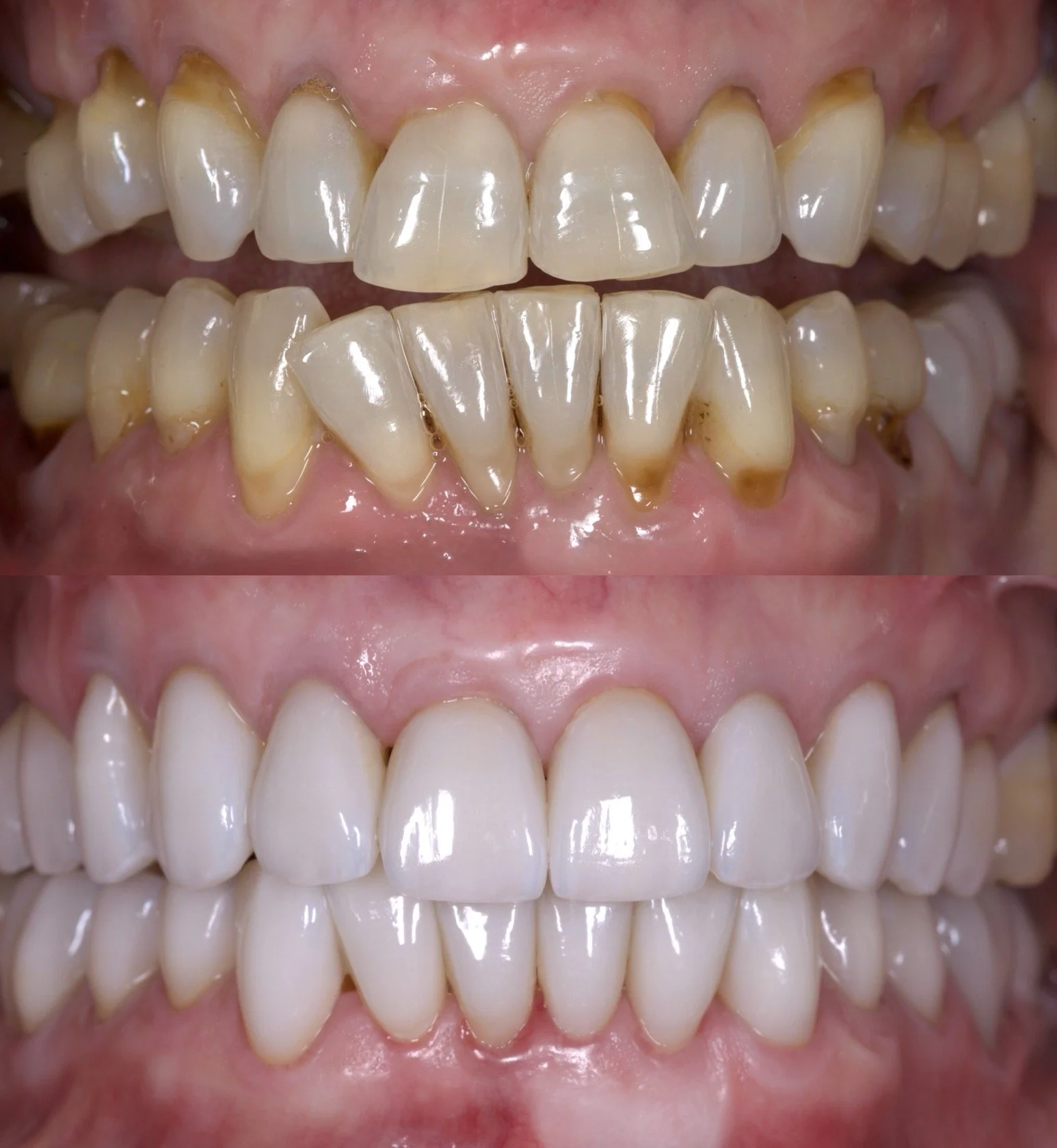 Invisalign + 20 Veneers