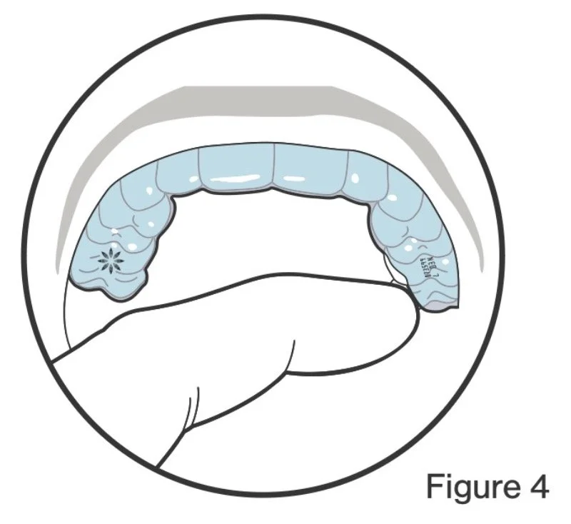 Person inserting a blue dental night guard into their mouth, with the hand visible holding it, against a circular background, labeled as Figure 4.