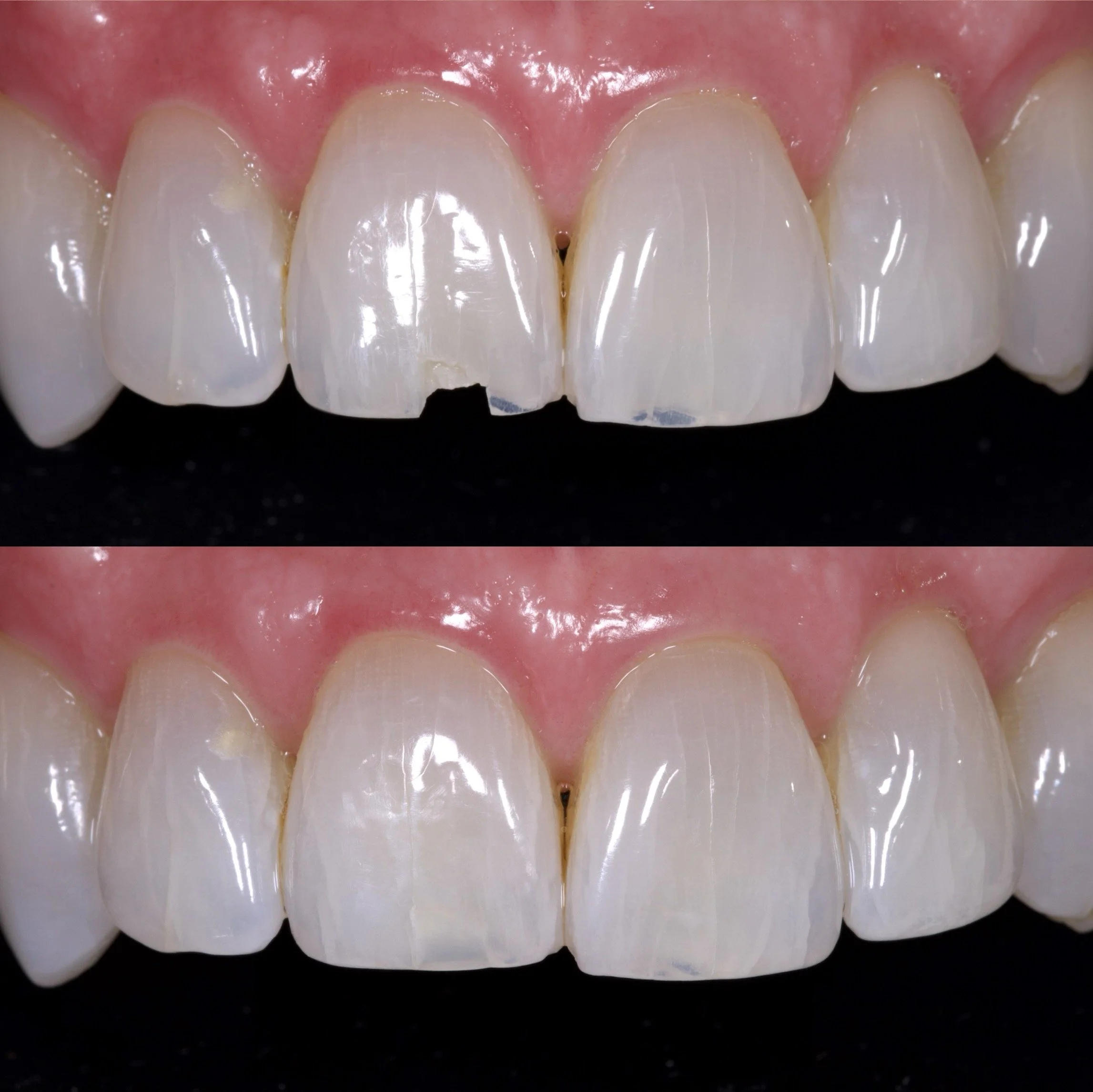 Resin Bonding A1 + Li