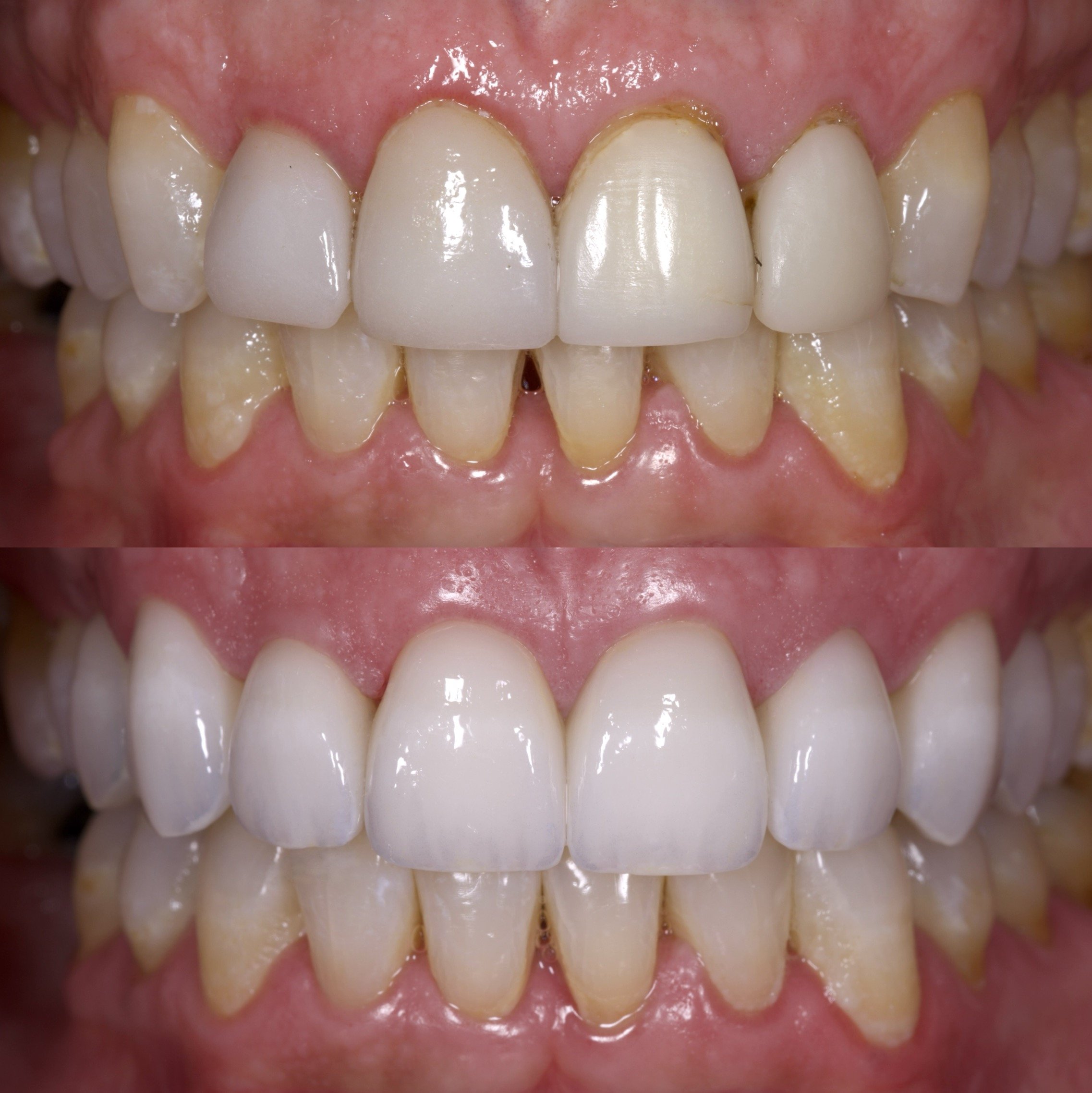 8 Veneers by Jeremy Heldt, DDS - Newport Beach Cosmetic Dentist