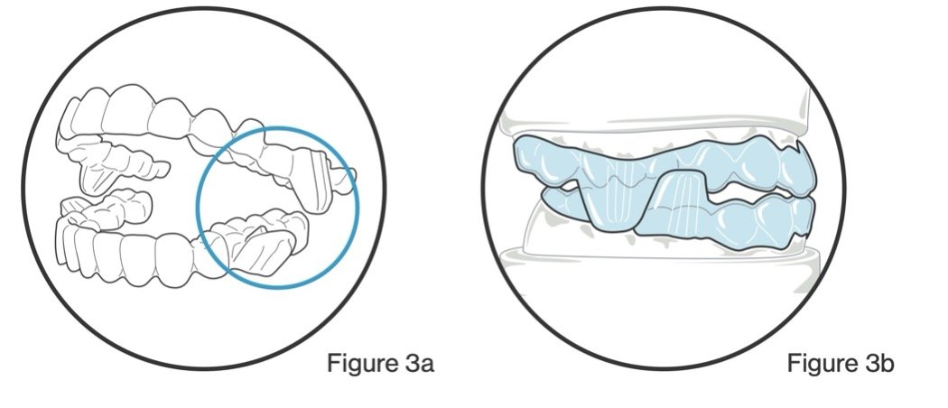 Diagram showing the alignment of human teeth, with a focus on a section of the molars, and a close-up of the teeth with dental impressions or molds in light blue.