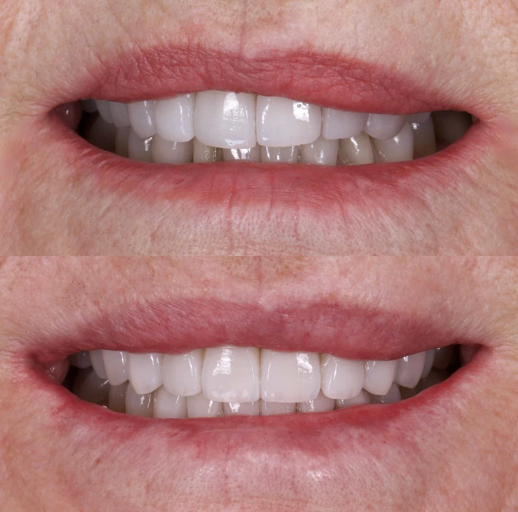 14 Veneers in Shade OM1