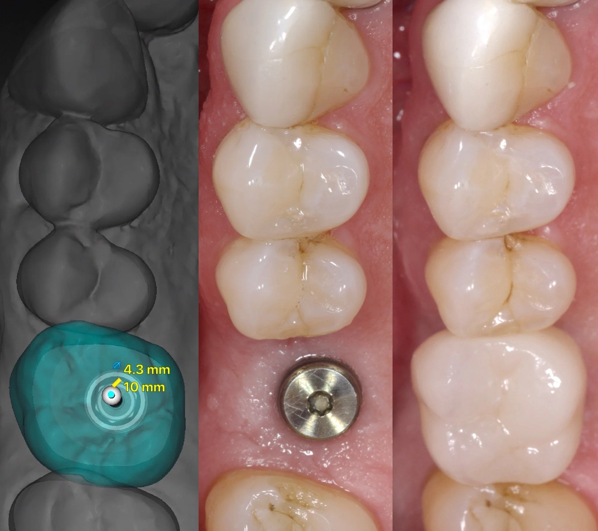 2 Implants + Crowns