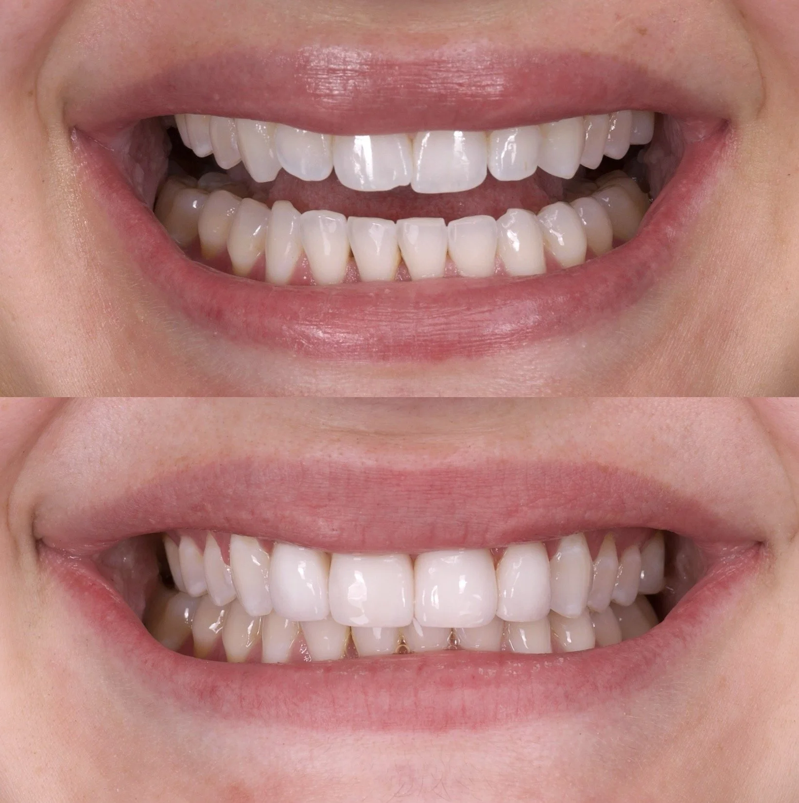 4 Minimal Prep Veneers in Shade 0.5M1