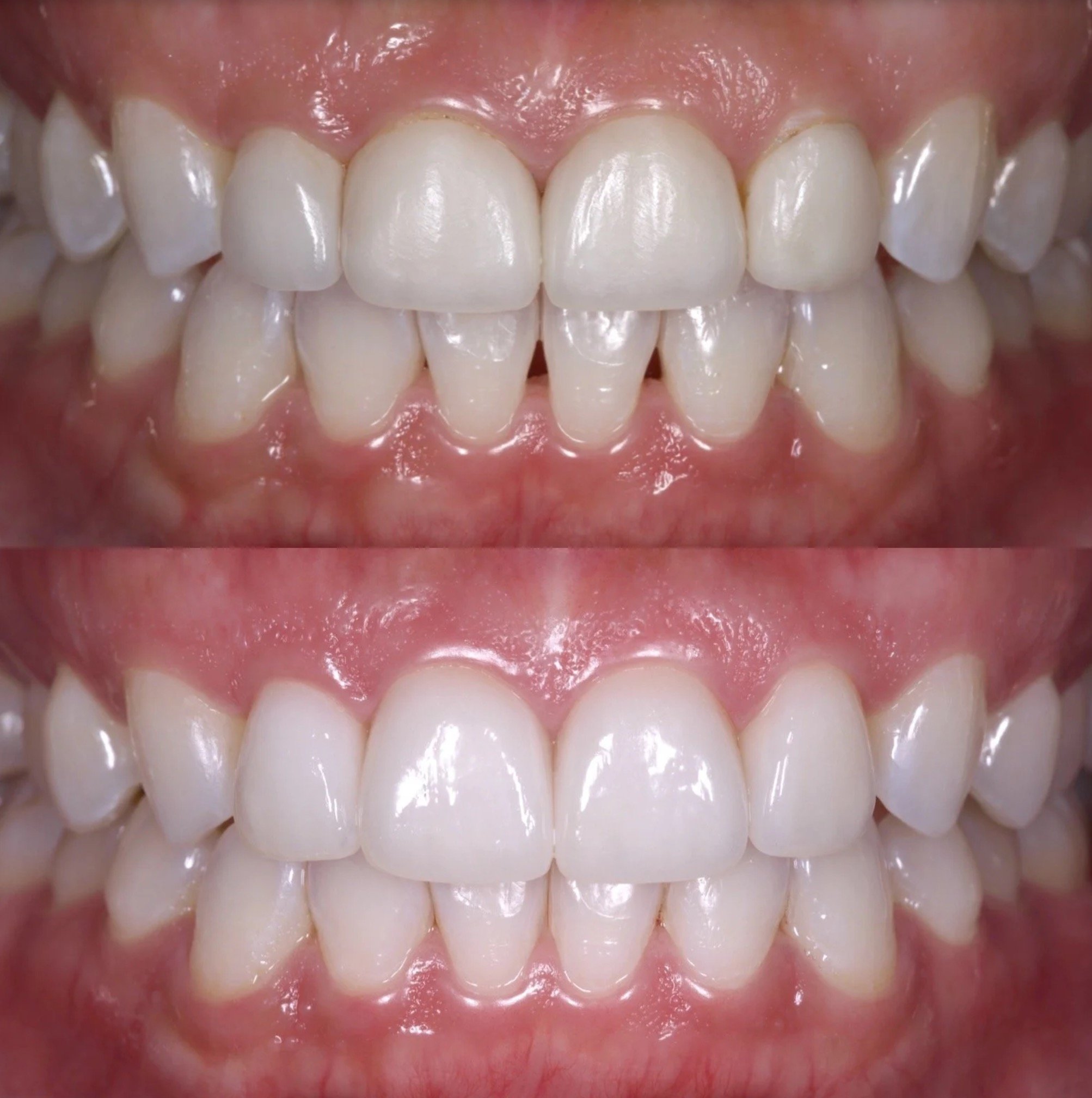 Veneers + Invislagn in Newport Beach by Jeremy Heldt, DDS