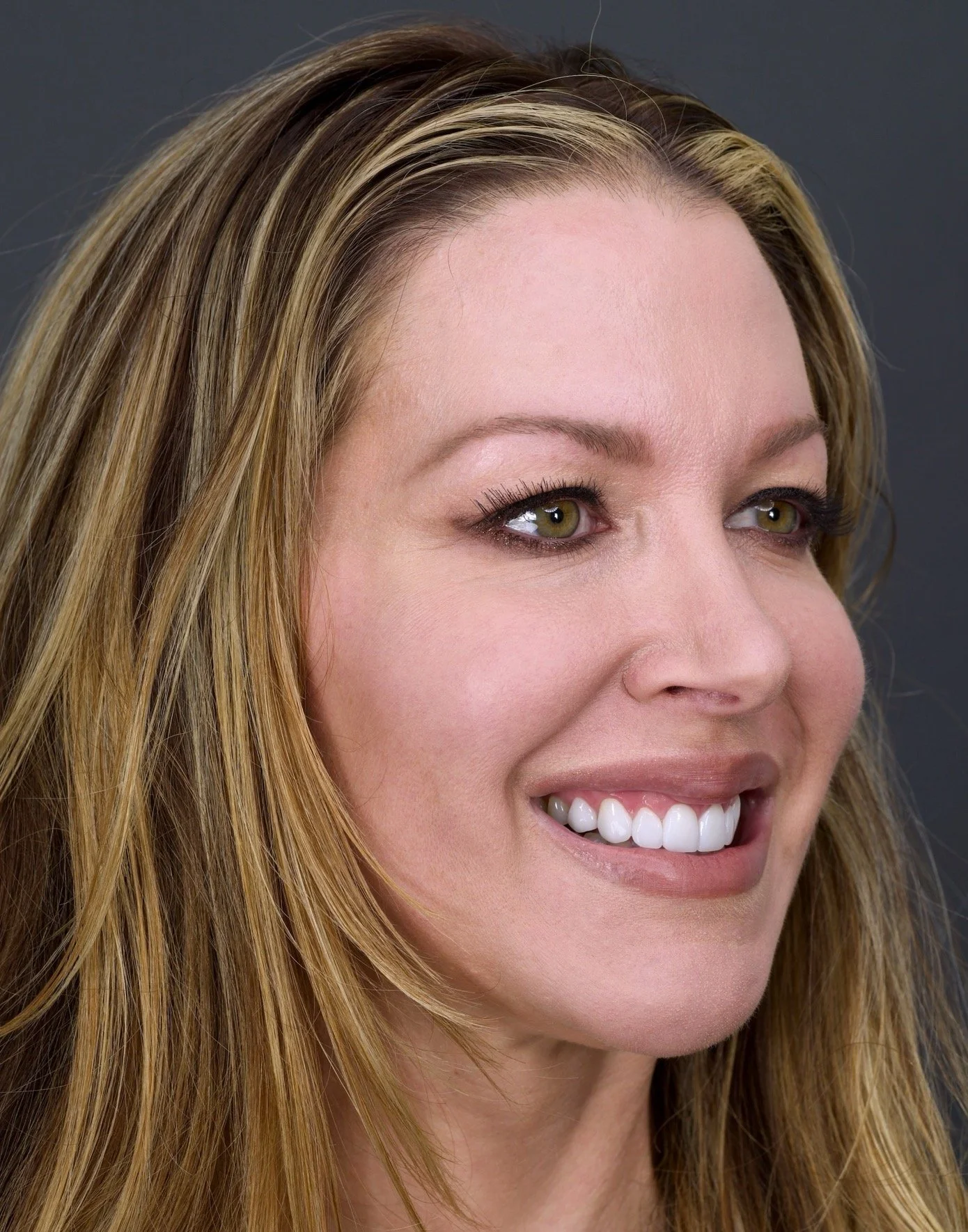 Porcelain Veneers, Orange County