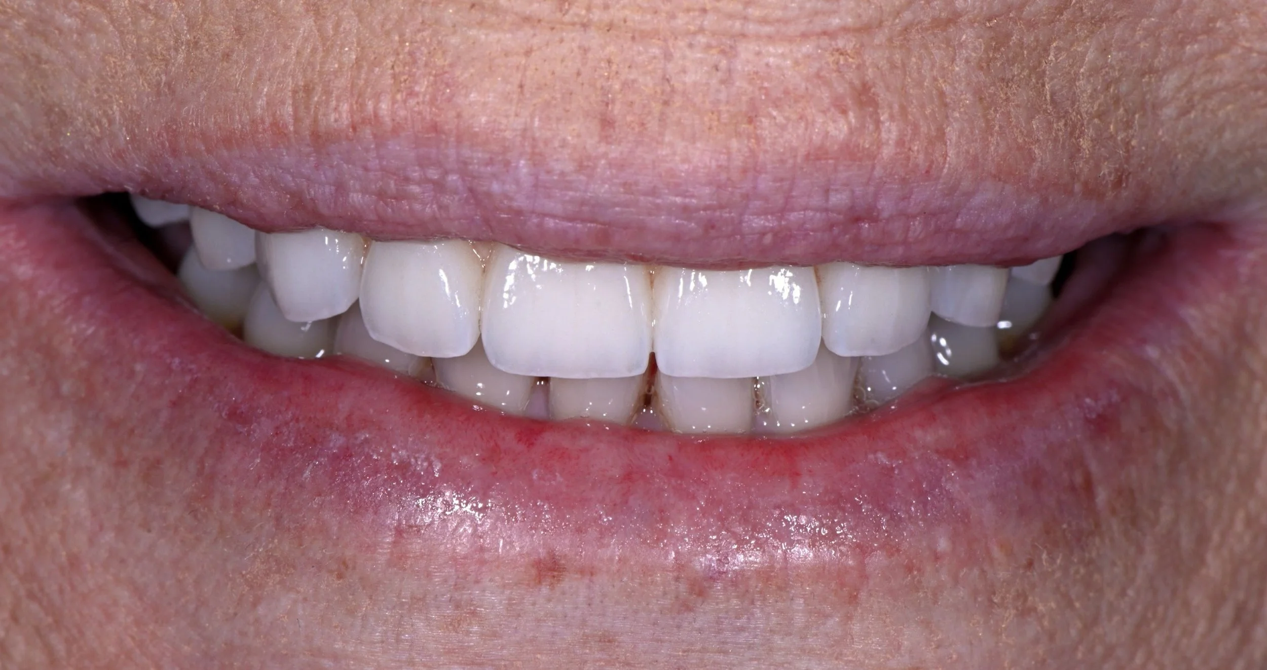 All-on-5 Dental Implants