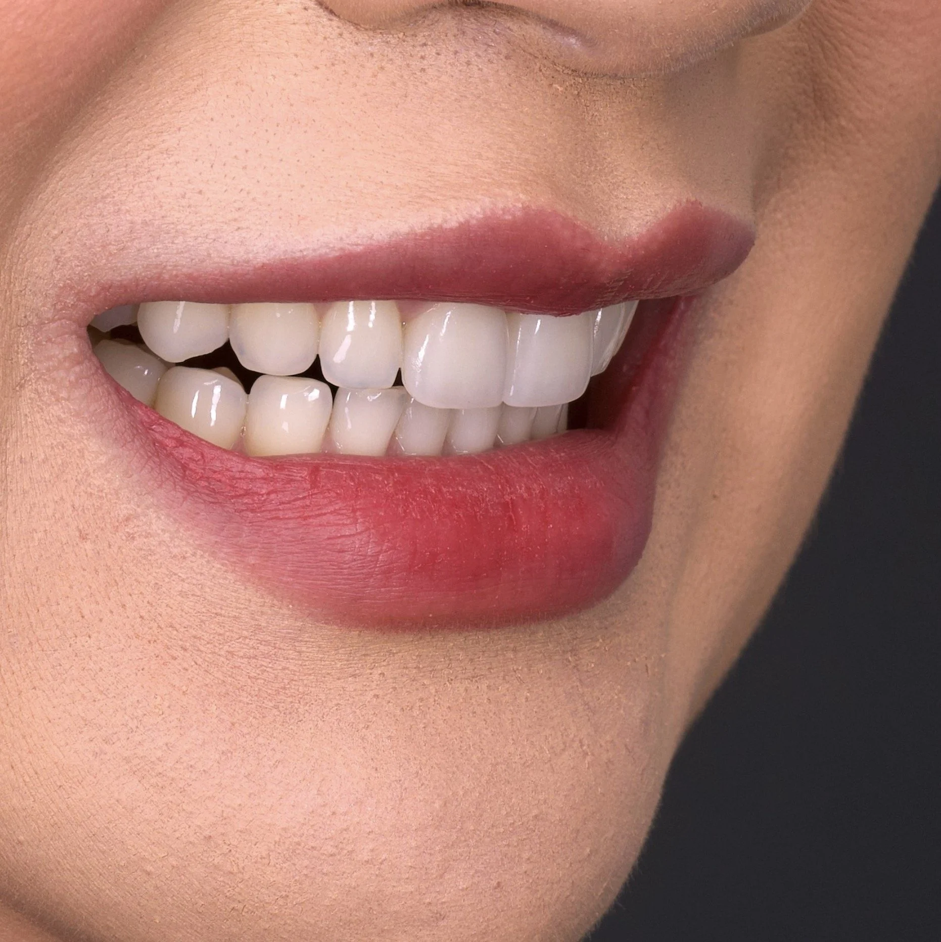 2 Front Teeth Veneers