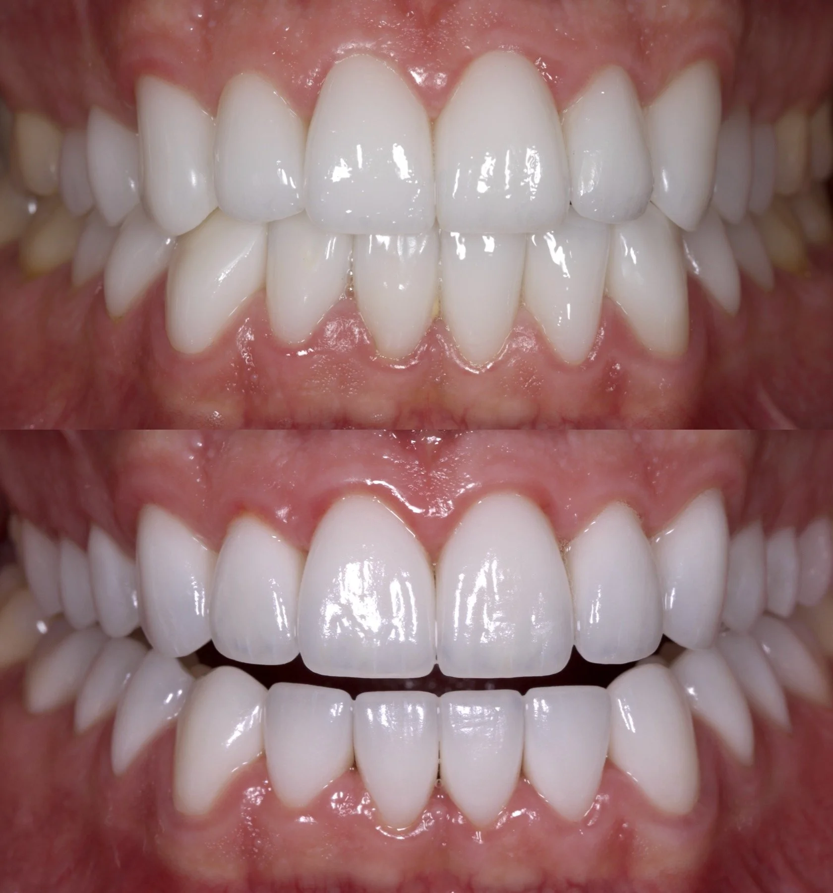 28 Veneers in High Translucency BL2