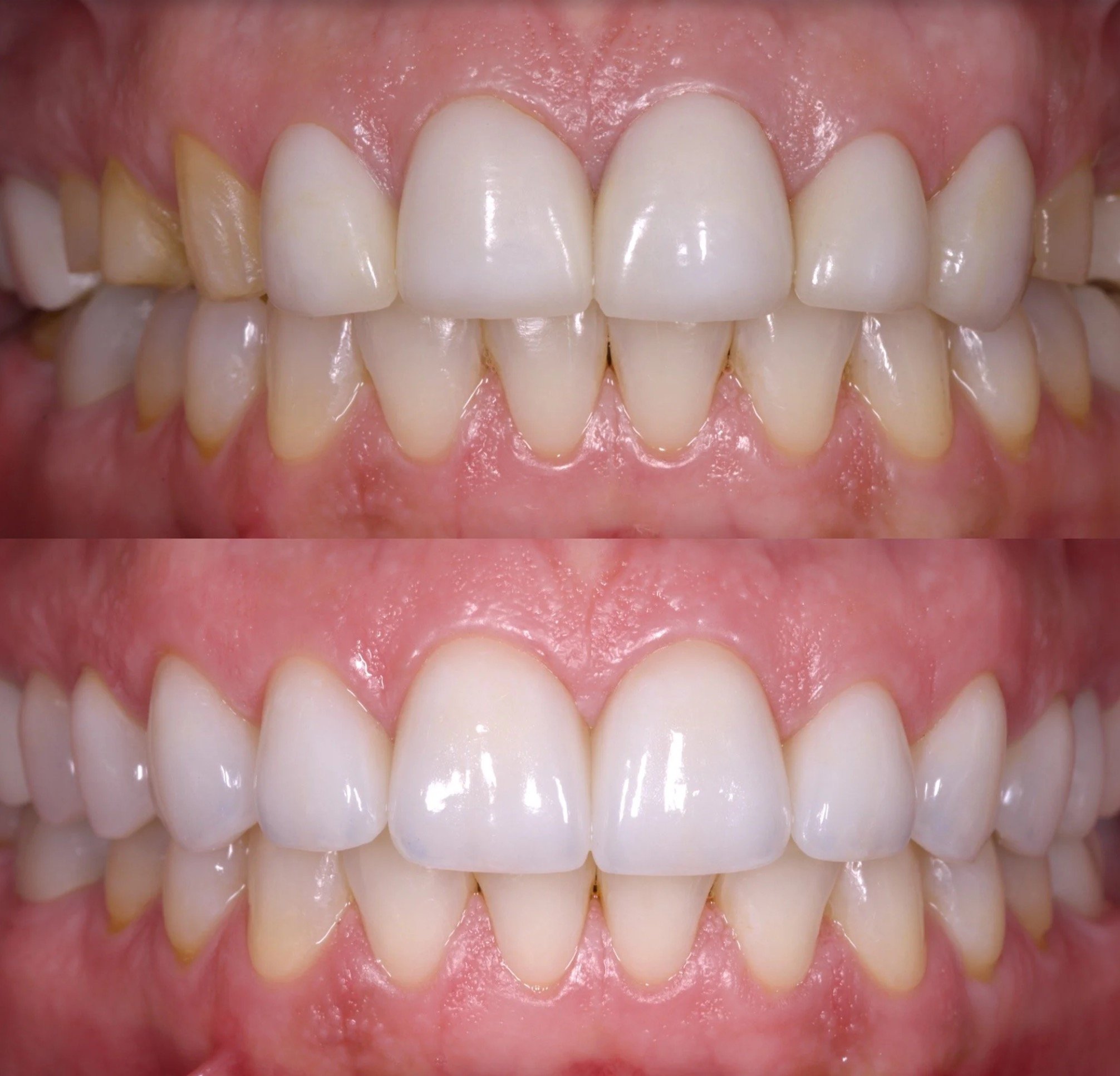 Veneers in Newport Beach by Jeremy Heldt, DDS