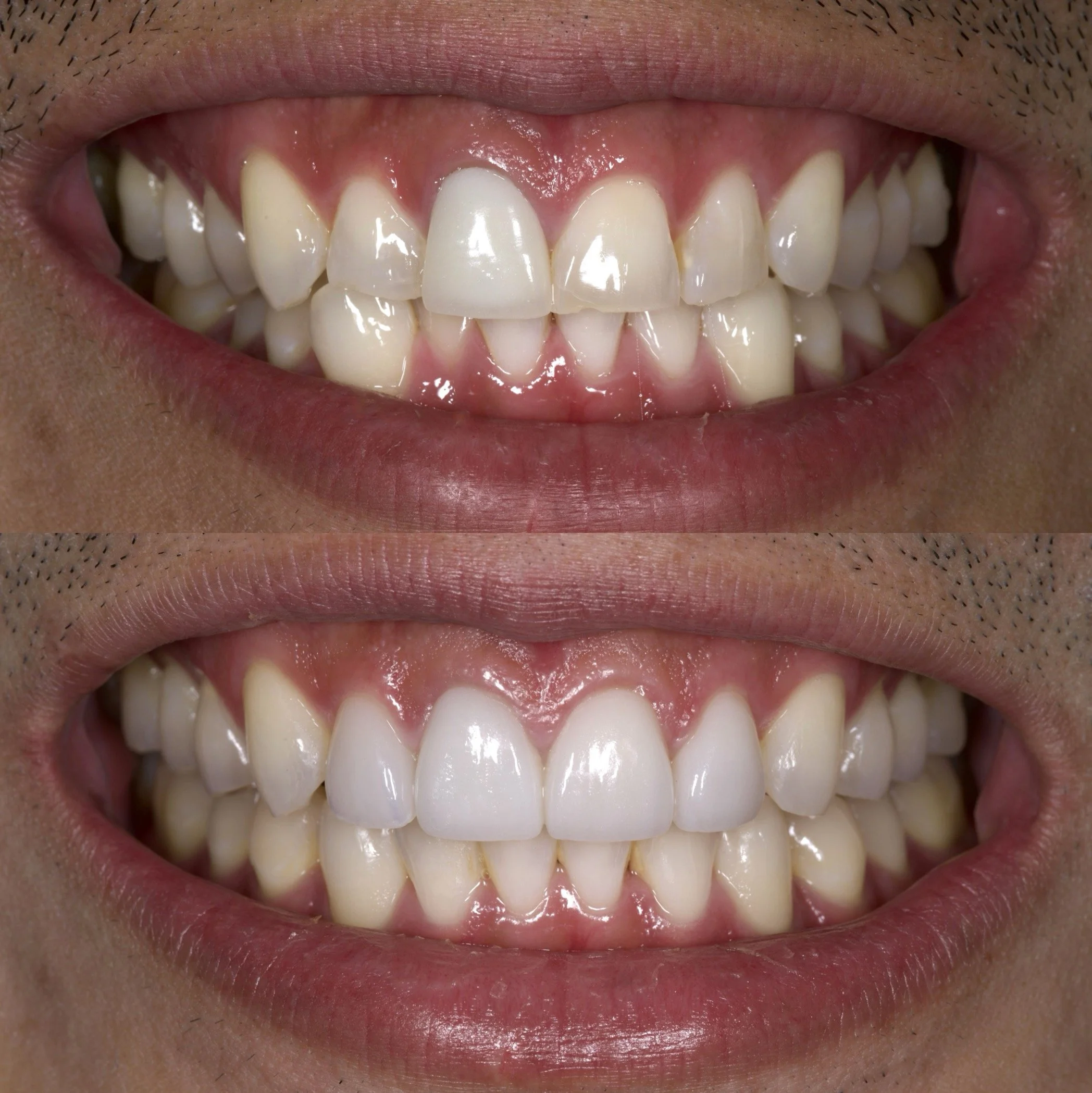 4 Veneers in Shade 0.5M1