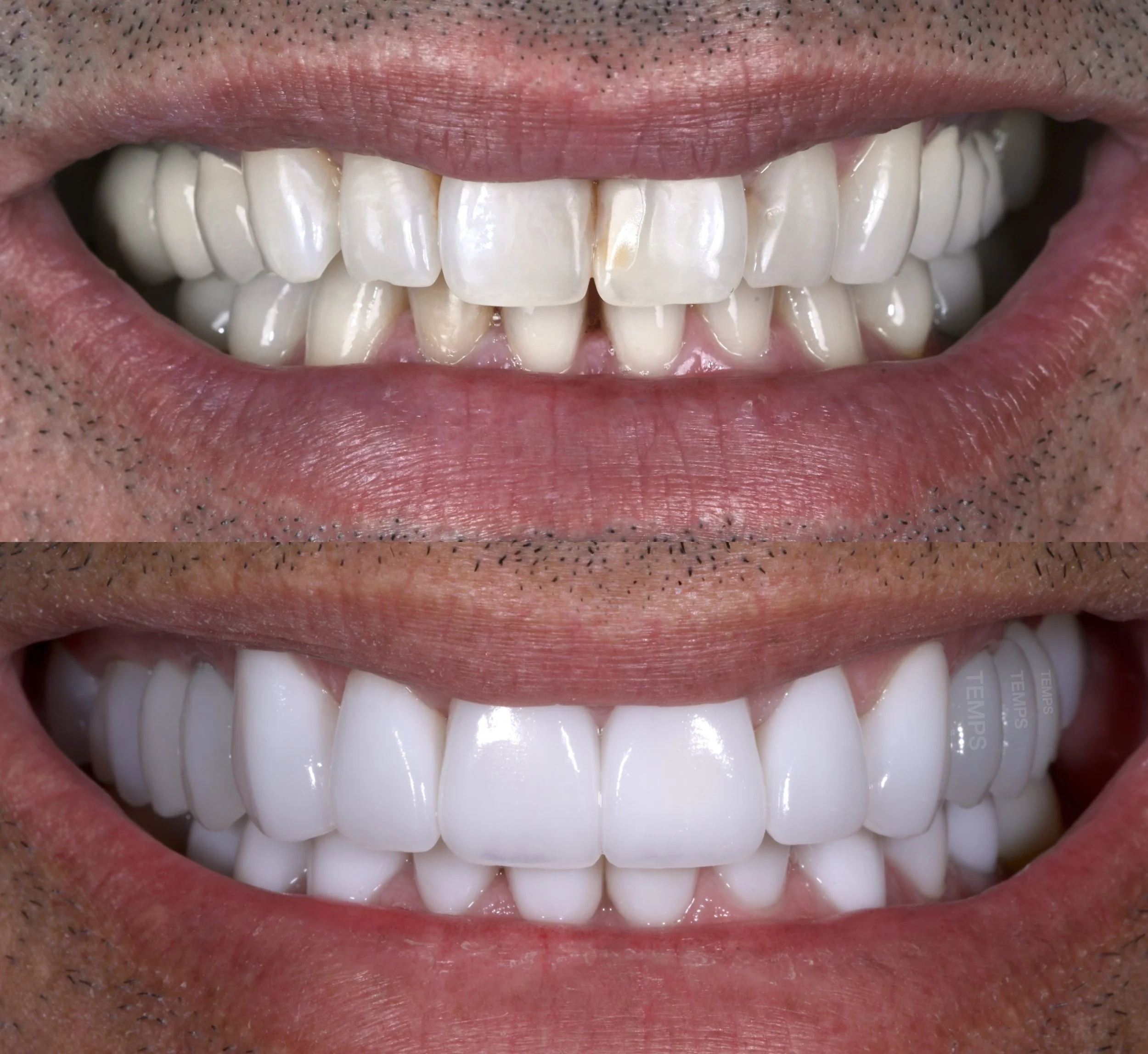 24 Veneers in Shade BL1