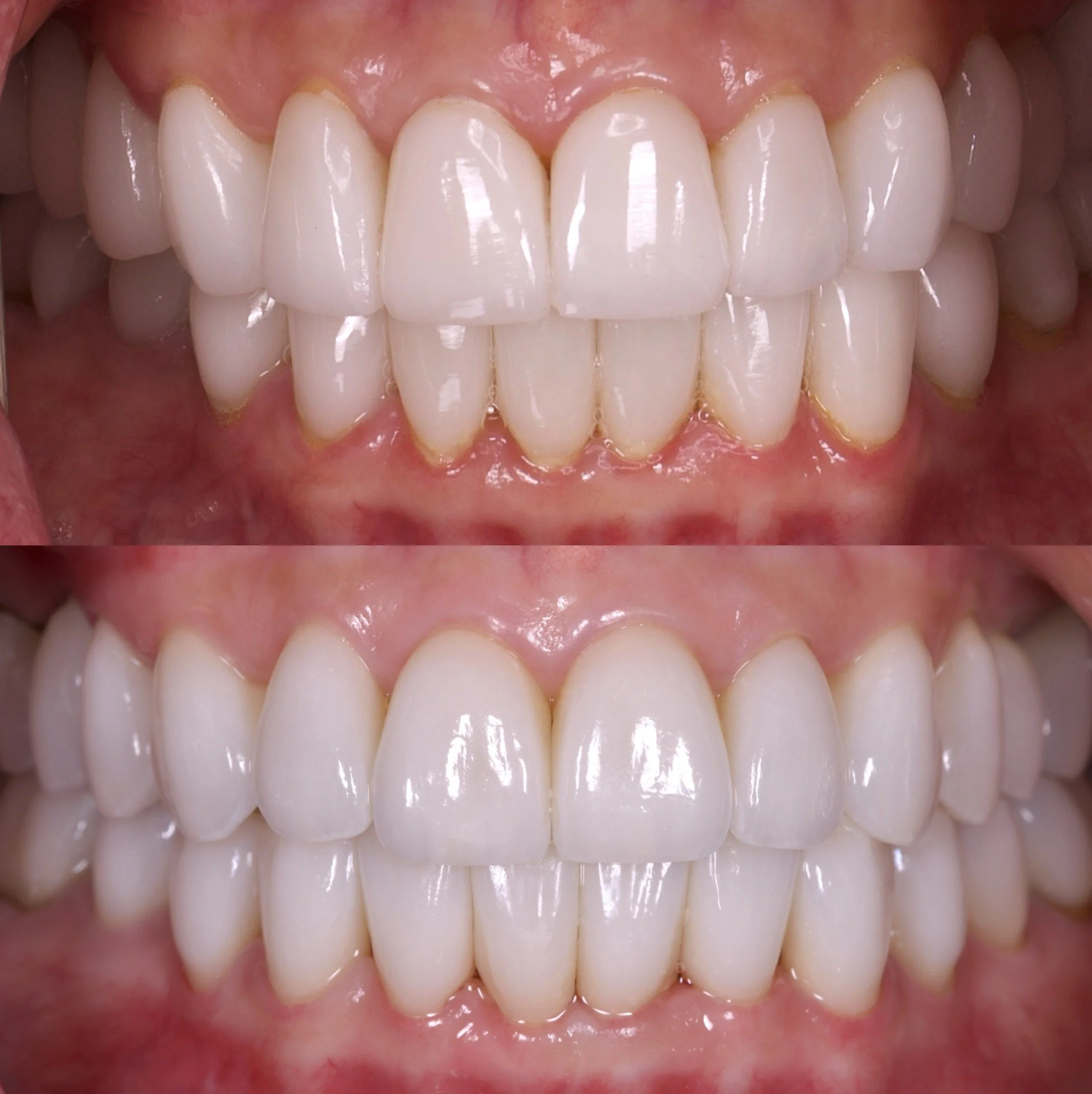 28 Veneers in Newport Beach by Cosmetic Dentist, Jeremy Heldt, DDS