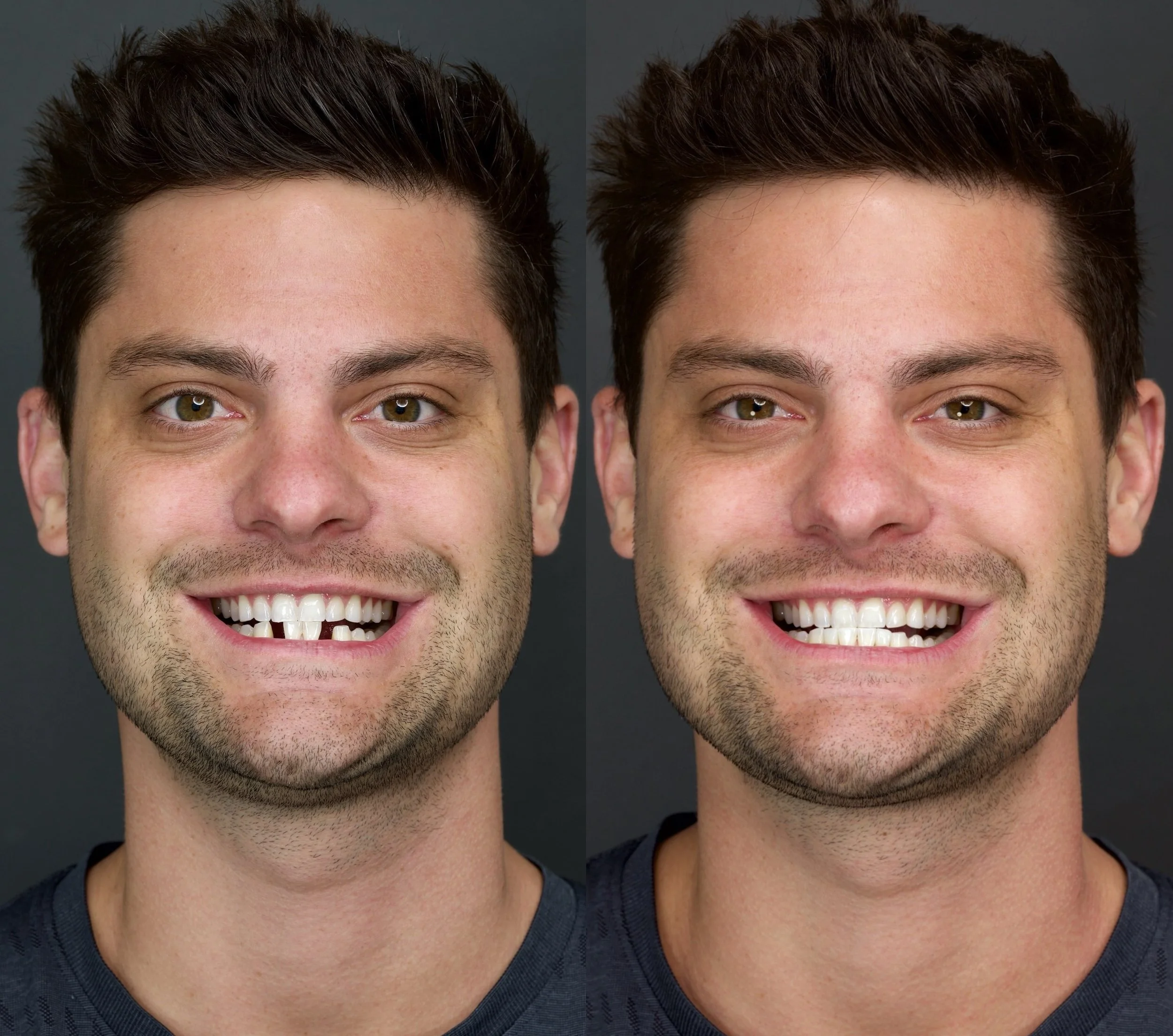 2 Lower Anterior Implants