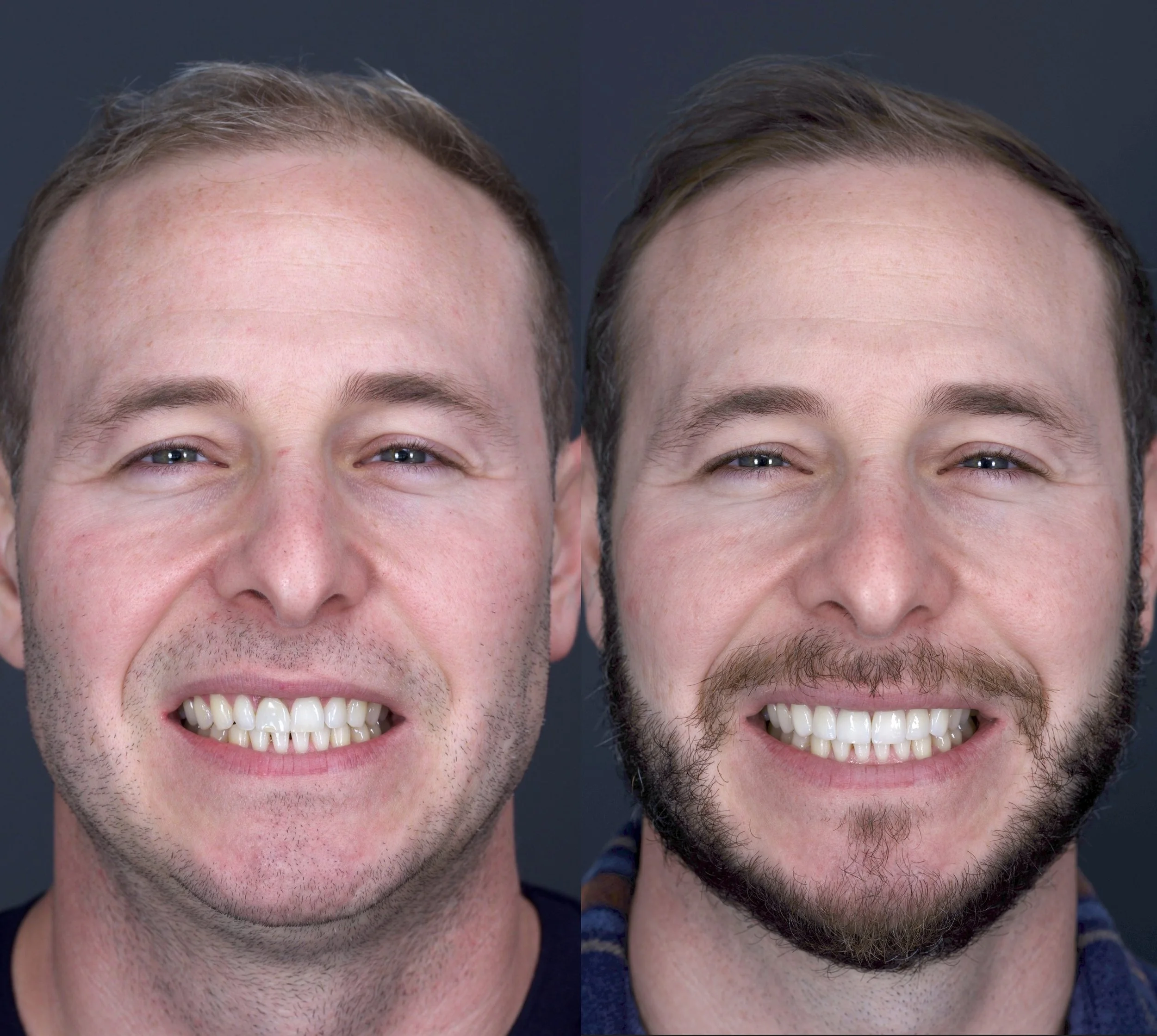 6 Porcelain Veneers