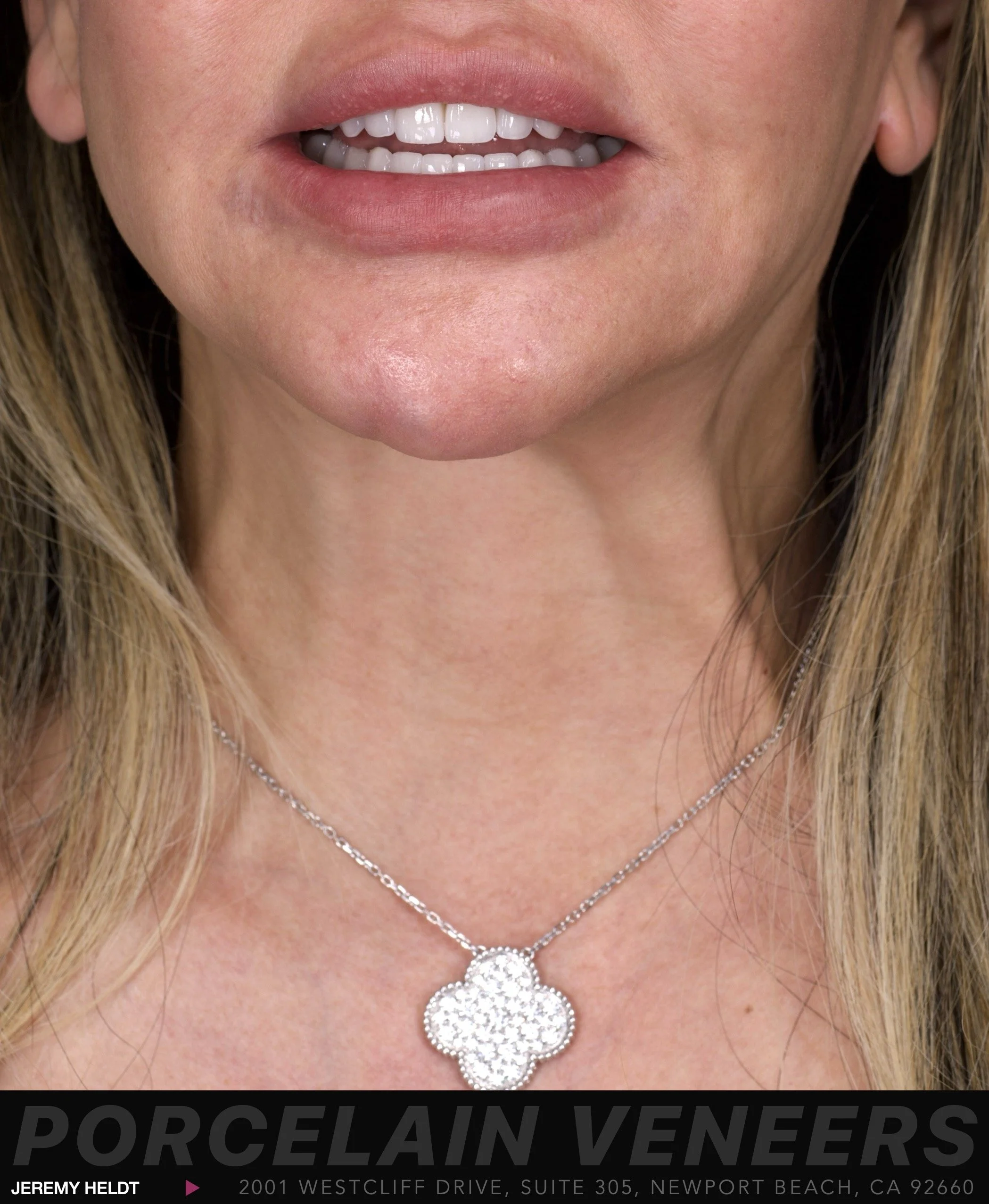 Veneers in Newport Beach by Jeremy Heldt, DDS
