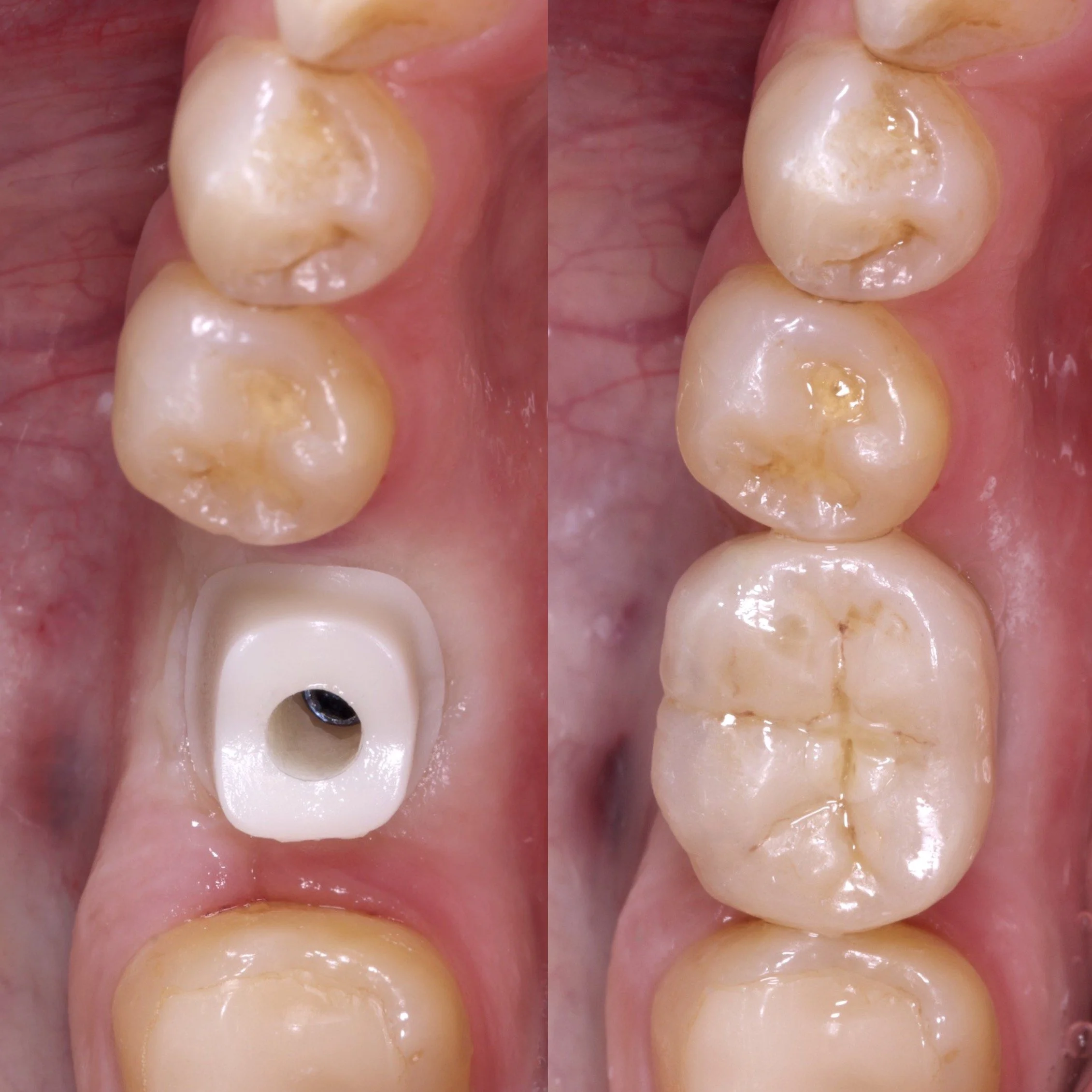Implant Crown, Shade A2