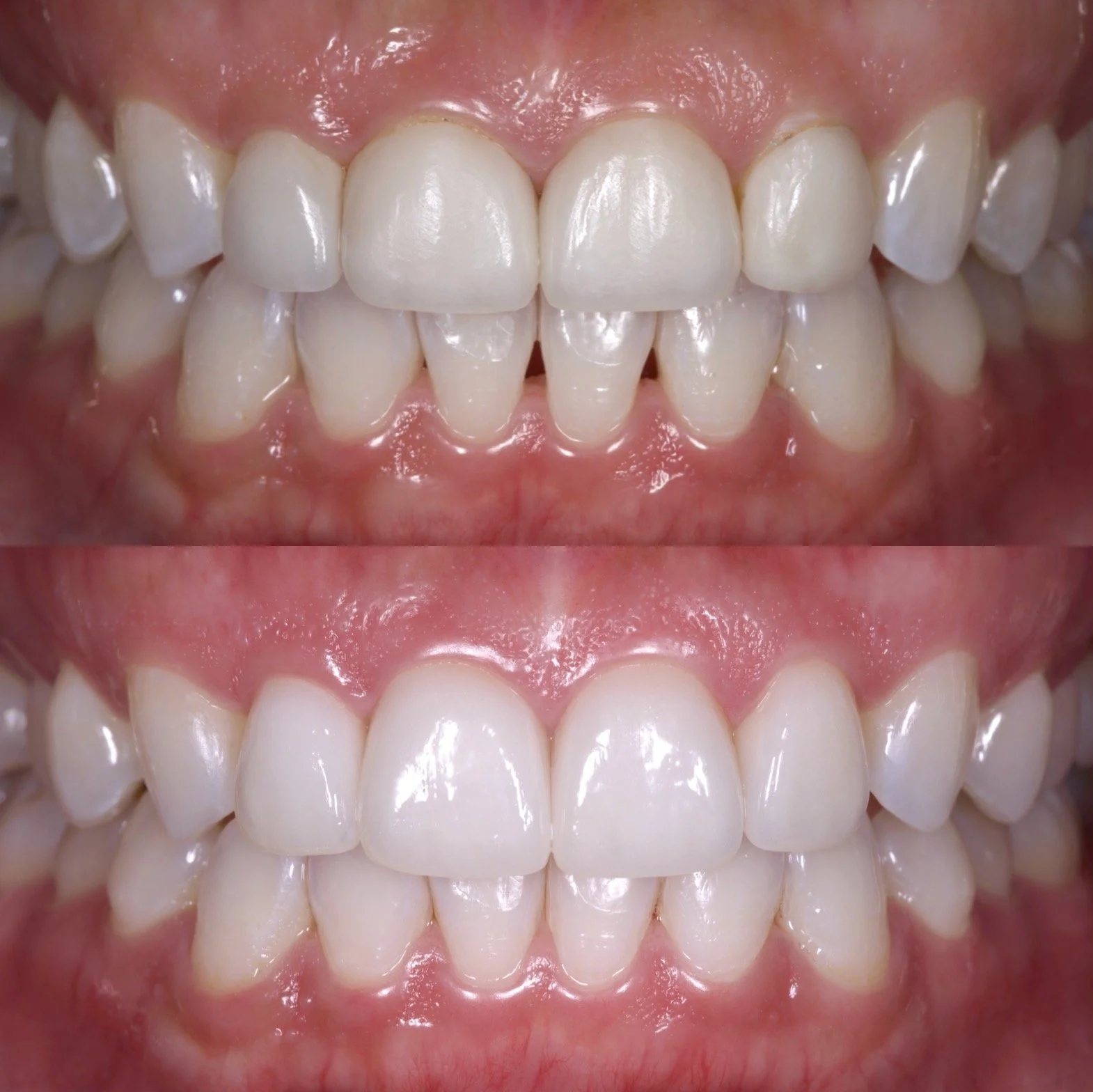 4 Veneers + Invisalign Express