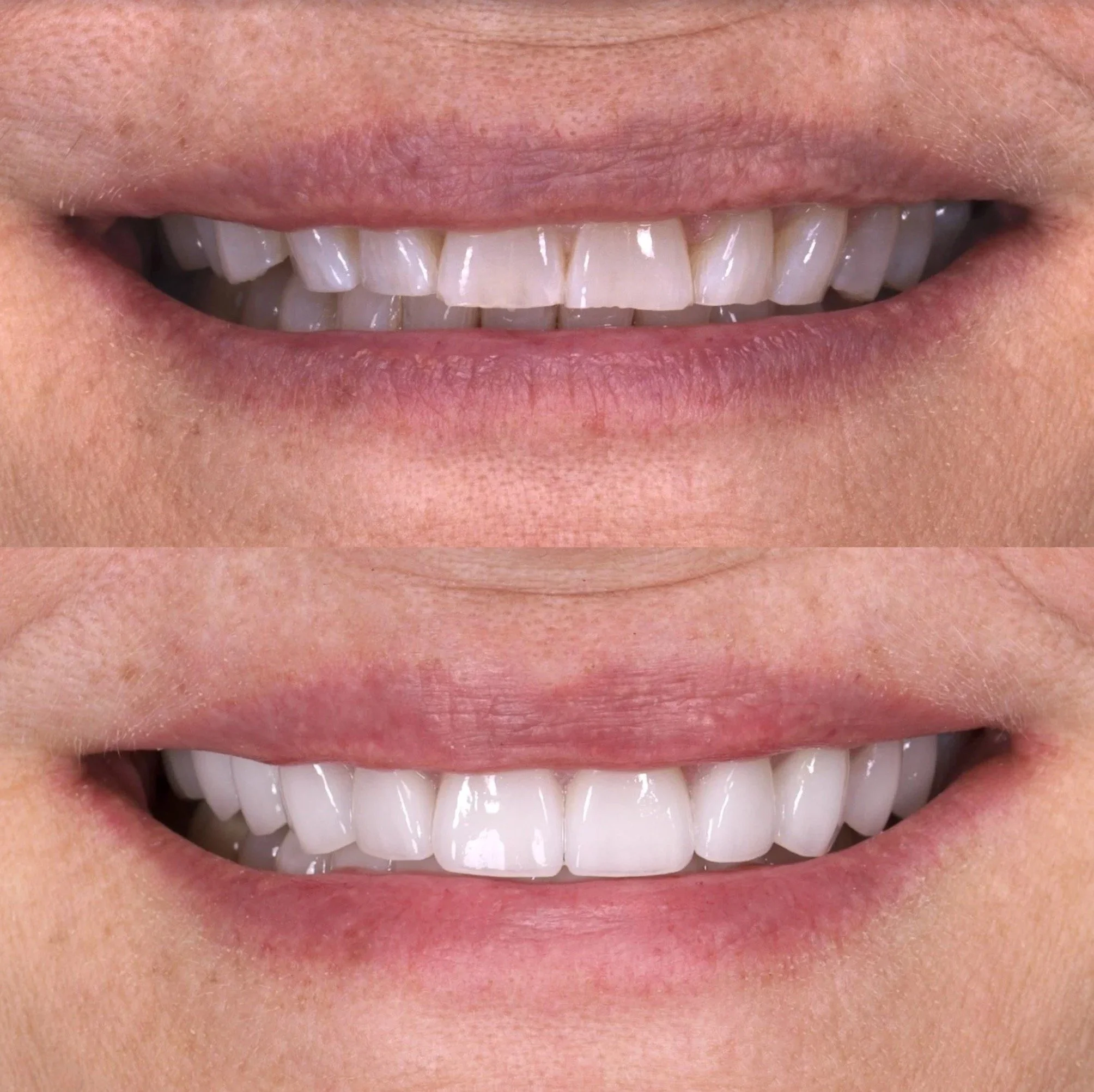 Veneers in Newport Beach by Jeremy Heldt, DDS