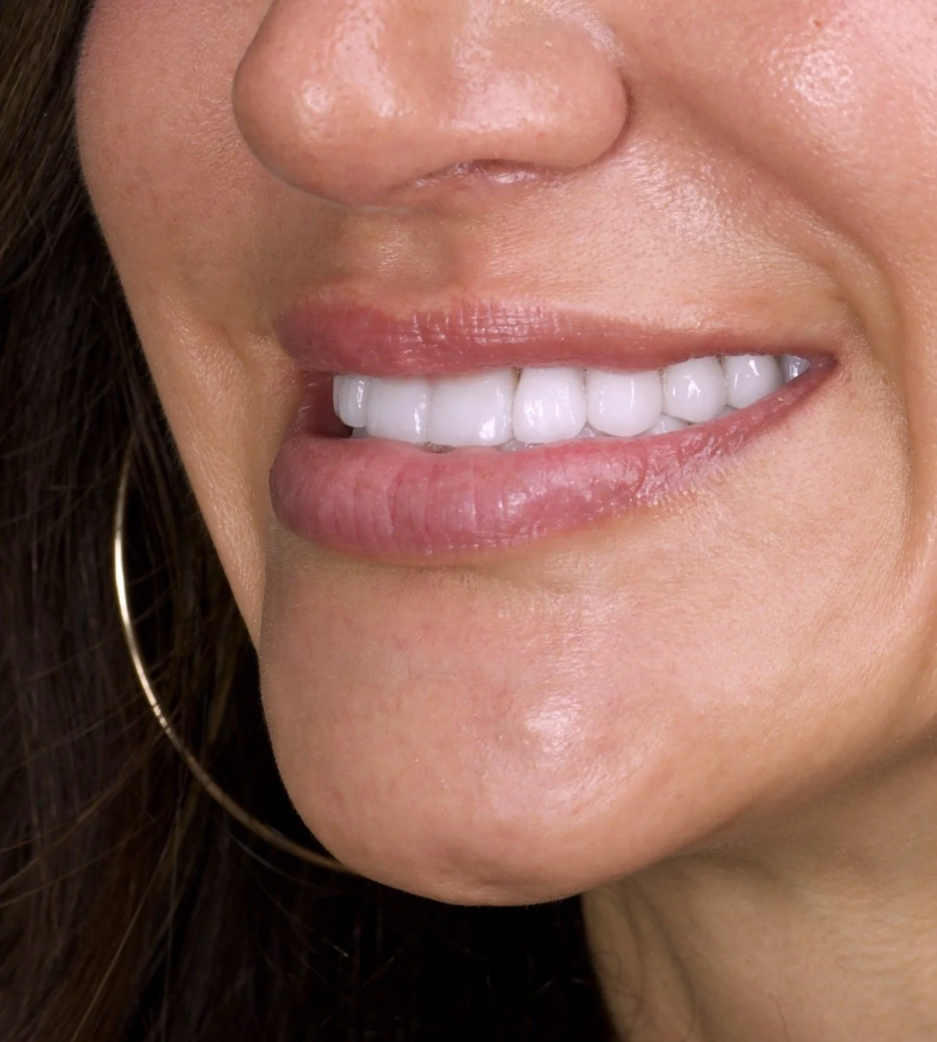 28 Veneers + 3 Implants in Shade BL2